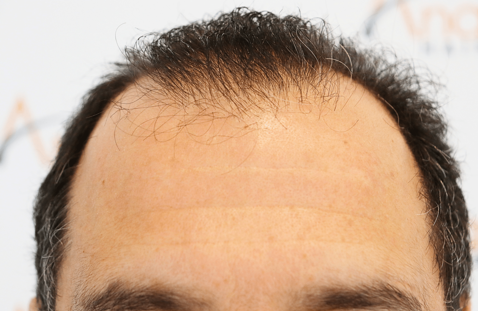 hair transplant result 2600 fus stage 5 diffused (15)