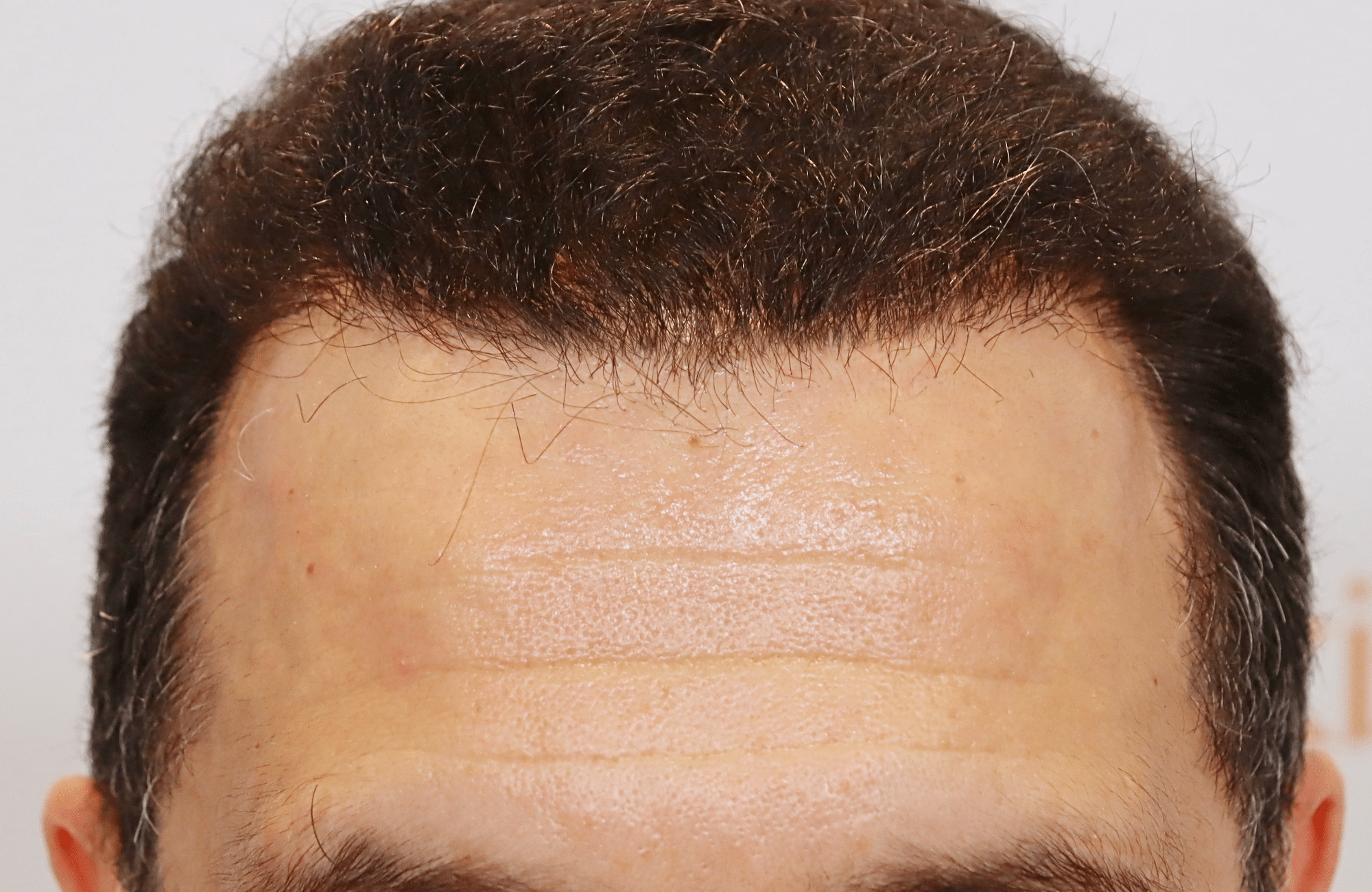 hair transplant result 2600 fus stage 5 diffused (16)
