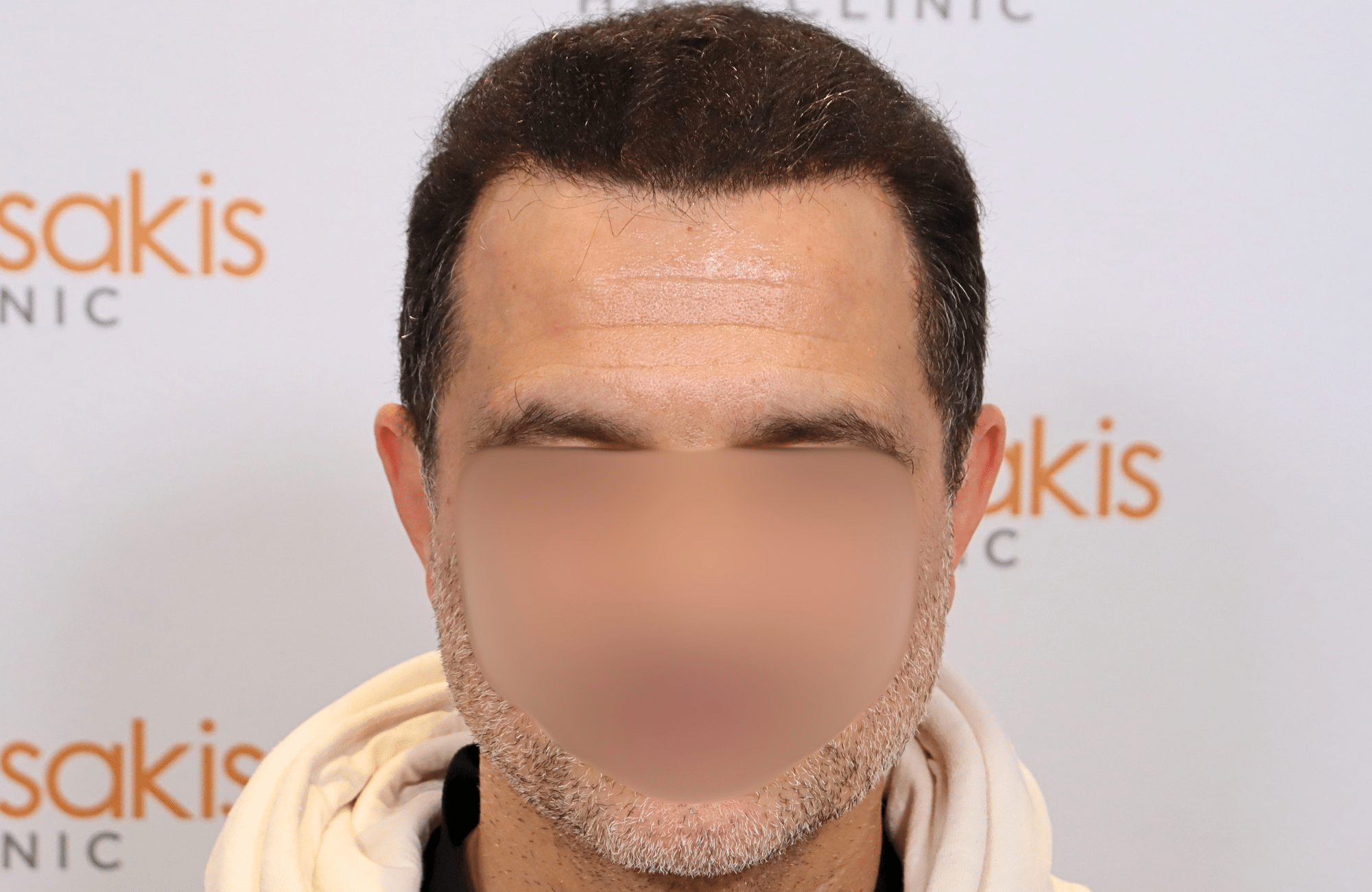 hair transplant result 2600 fus stage 5 diffused (4)