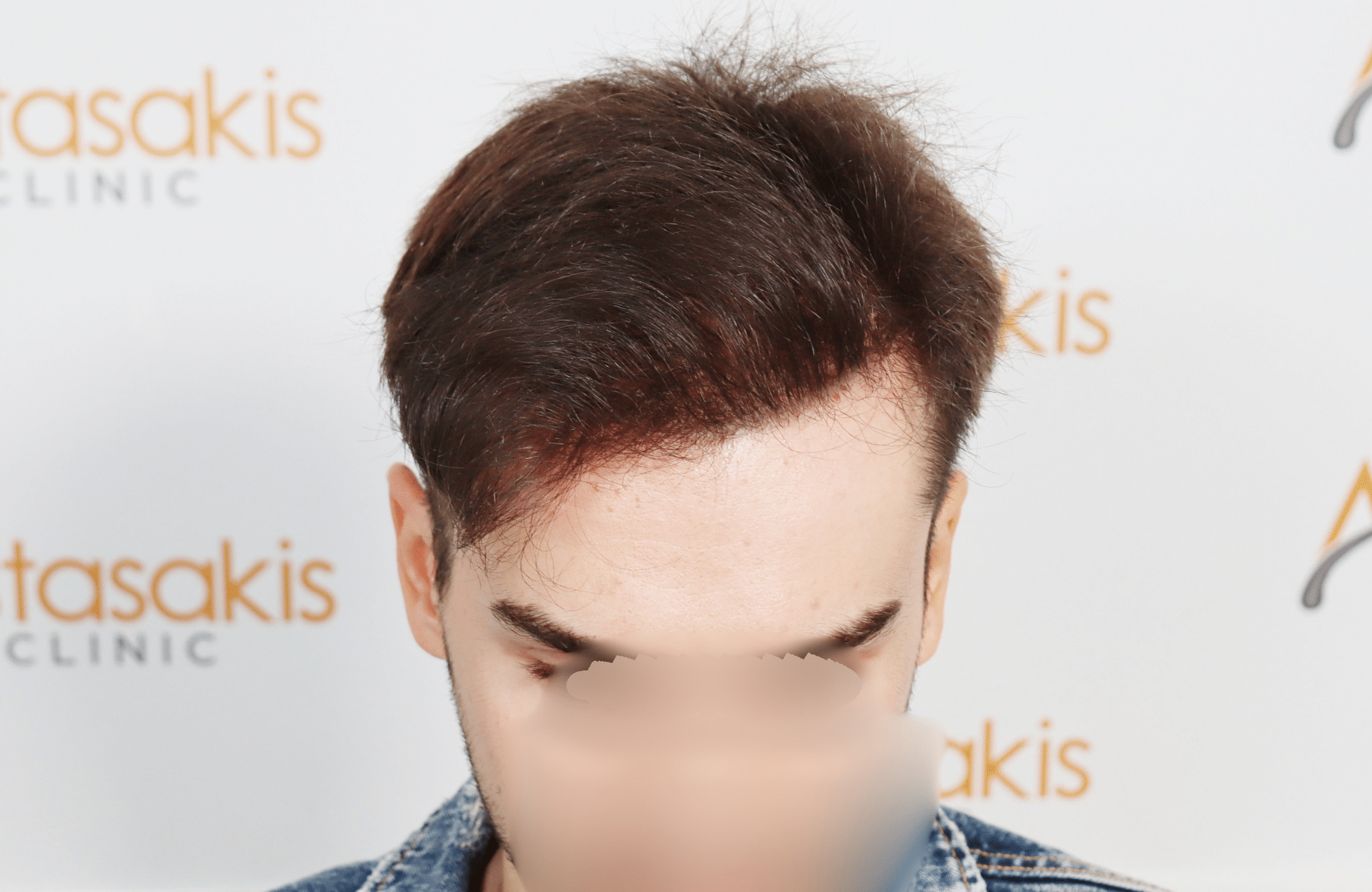 hair transplant result 2600 fus thick frontal stage 4 (3)