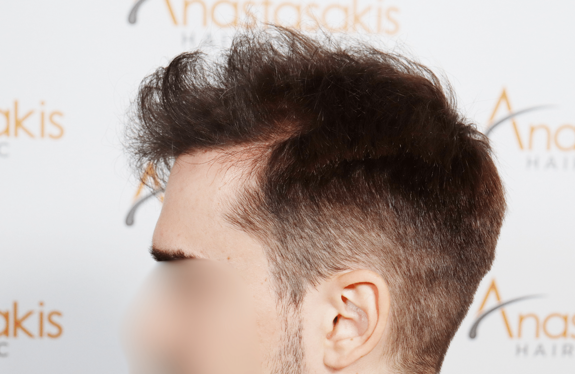 hair transplant result 2600 fus thick frontal stage 4 (3)