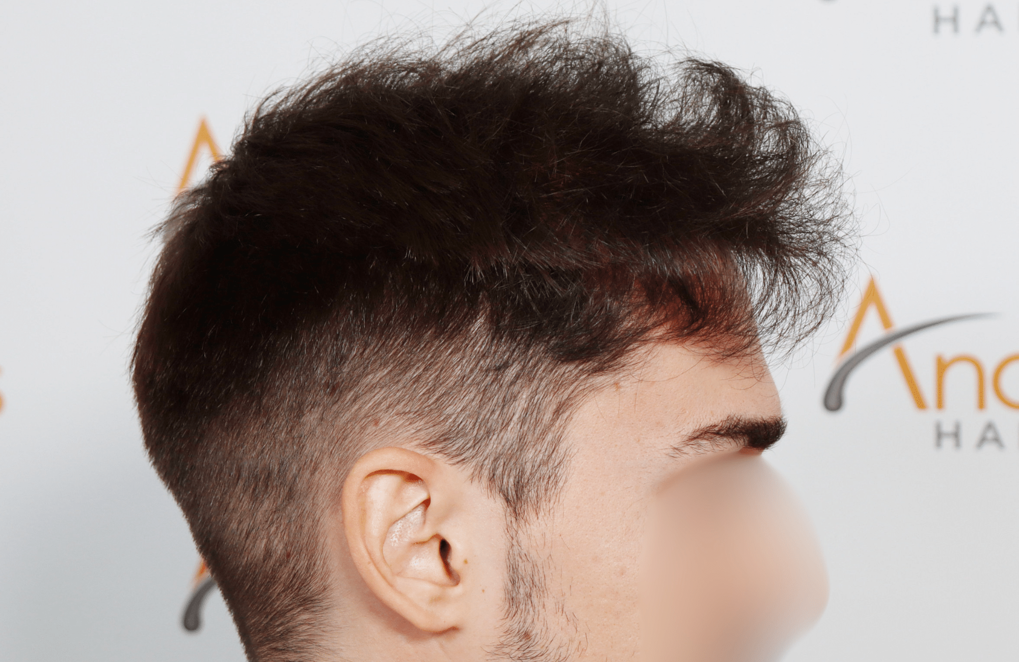 hair transplant result 2600 fus thick frontal stage 4 (3)