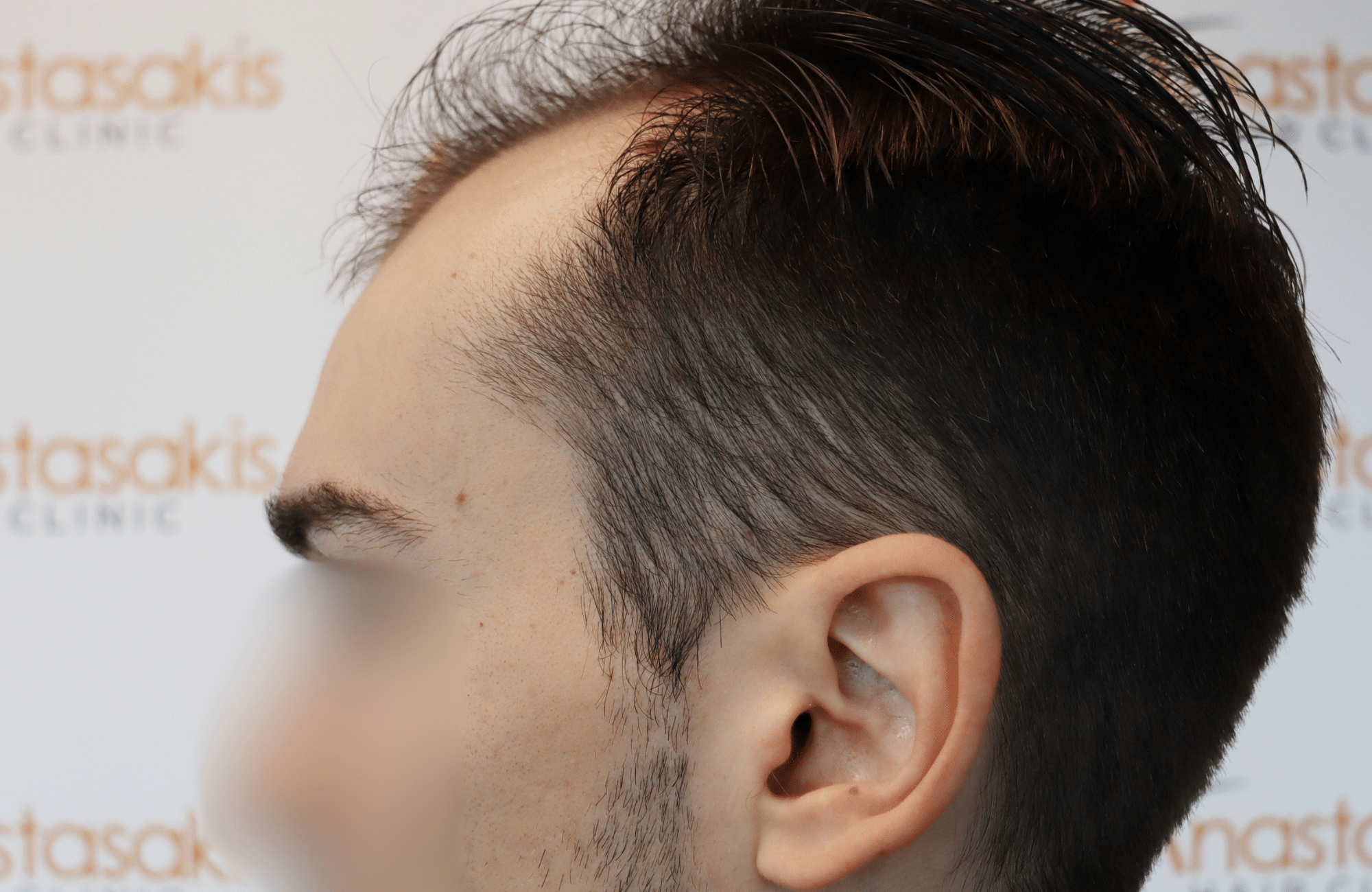 hair transplant result 2600 fus thick frontal stage 4 (3)