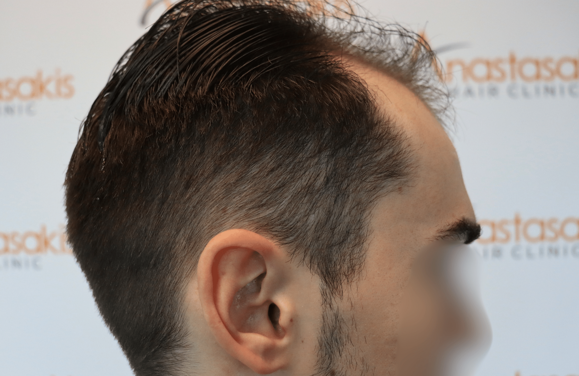 hair transplant result 2600 fus thick frontal stage 4 (3)