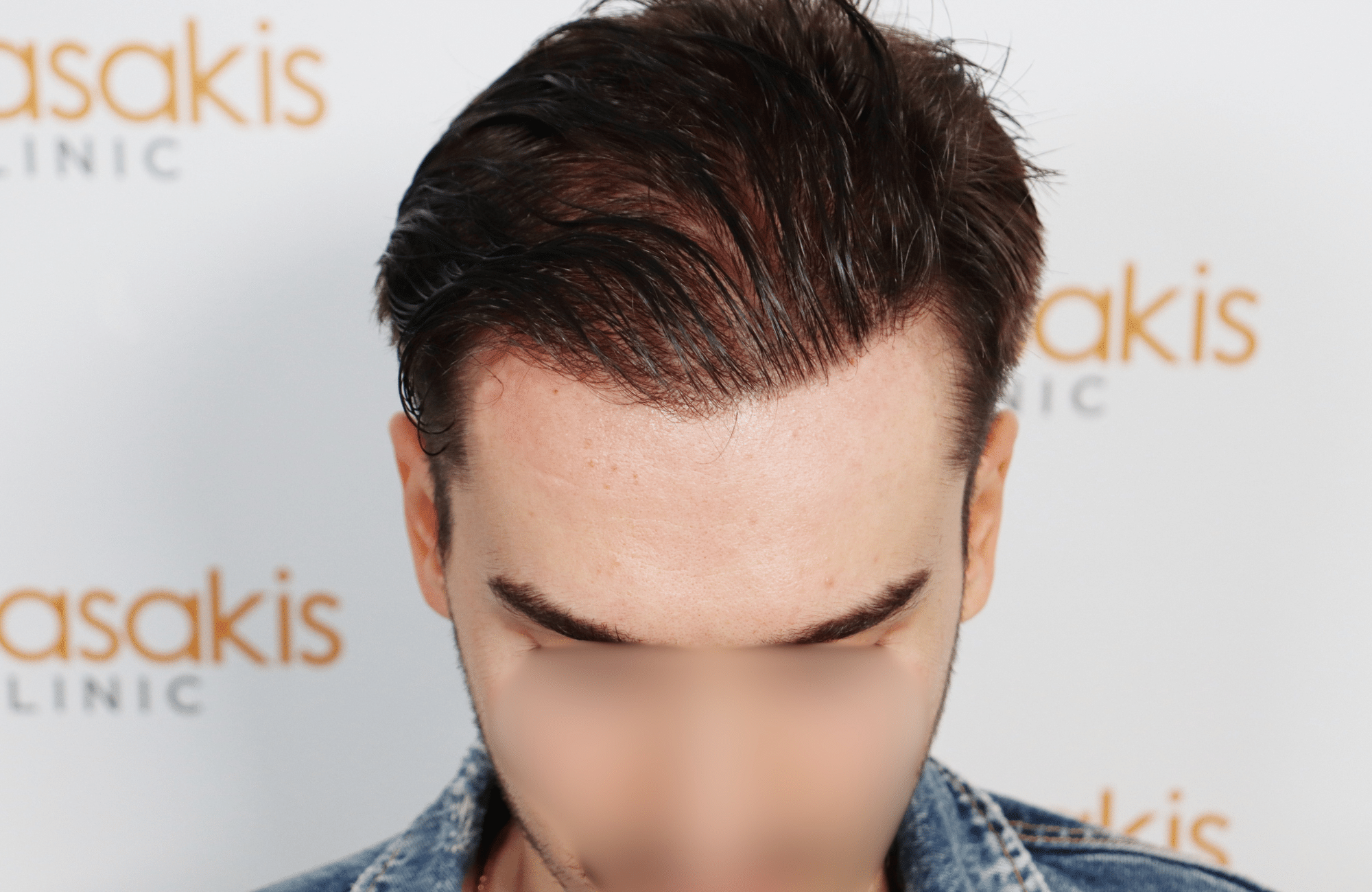 hair transplant result 2600 fus thick frontal stage 4 (3)