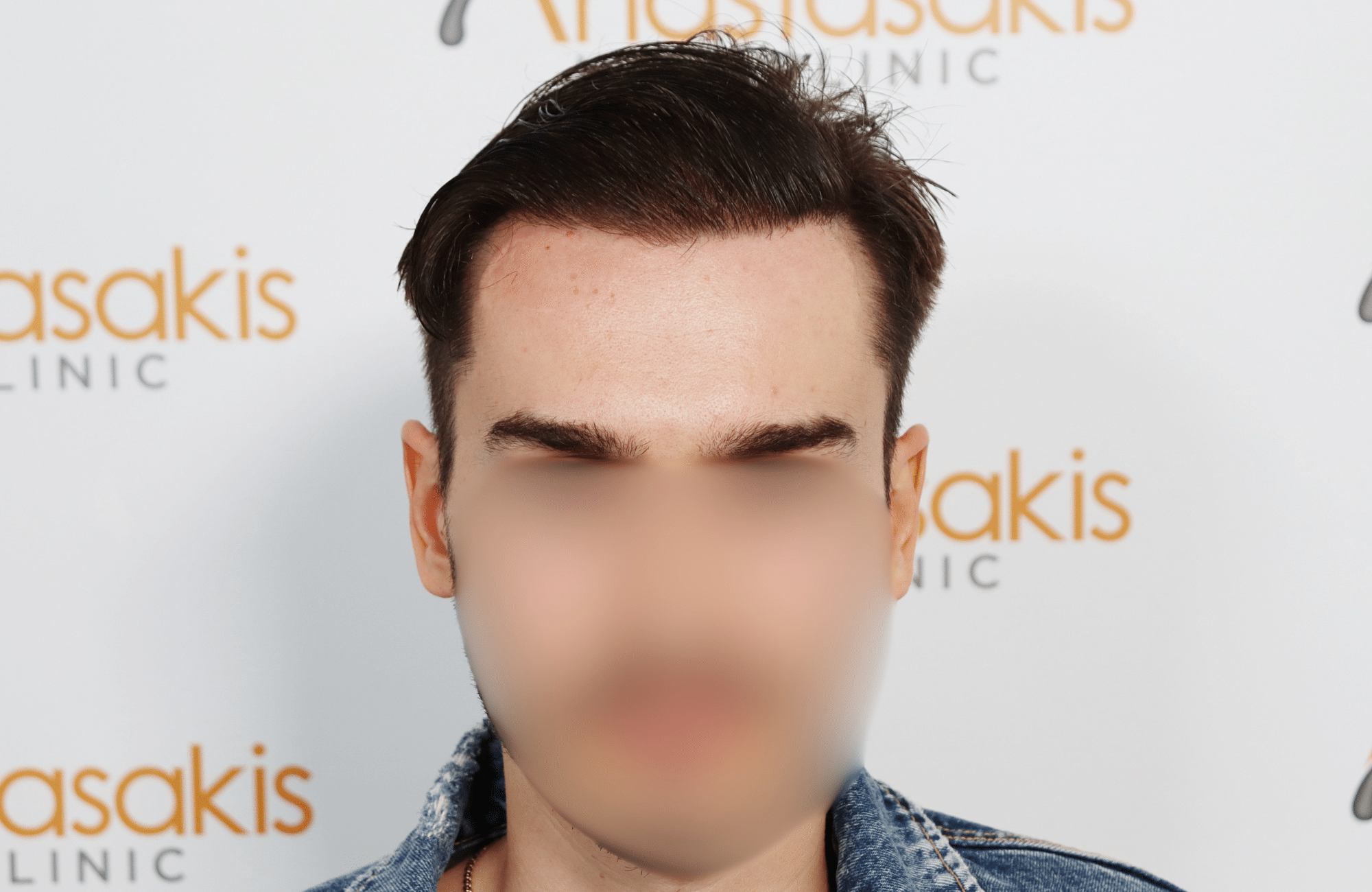 hair transplant result 2600 fus thick frontal stage 4 (3)