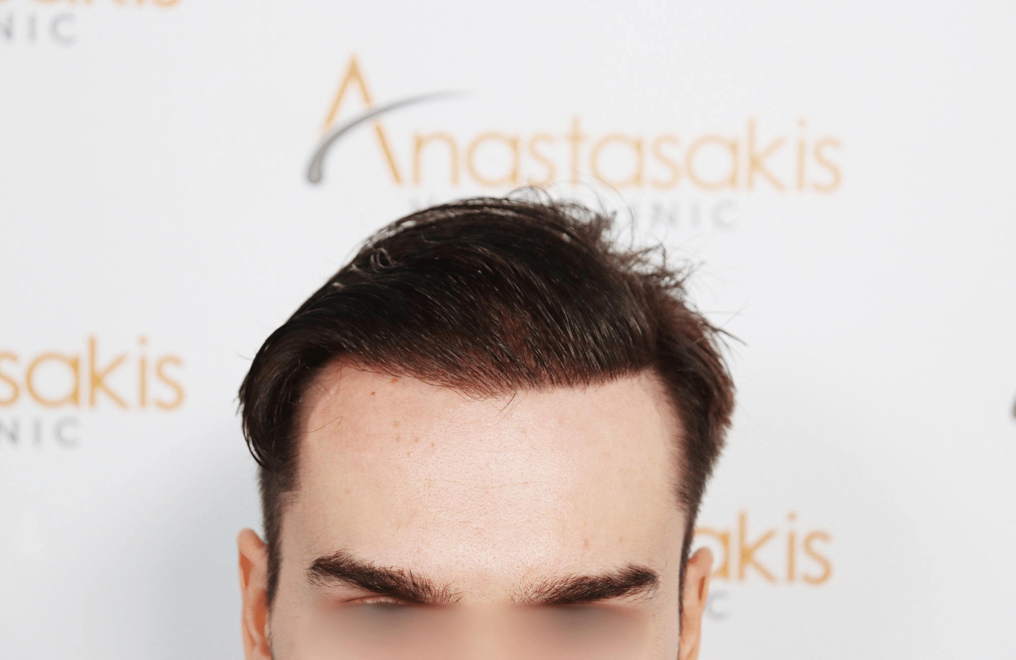 hair transplant result 2600 fus thick frontal stage 4 (3)