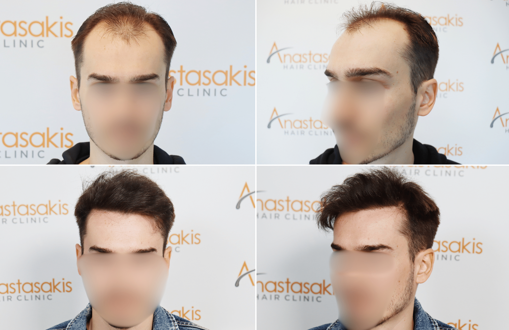 https://www.anastasakishairclinic.gr/portfolio/apotelesma-metamosxefsis-mallion-anastasakis-hair-clinic-218/