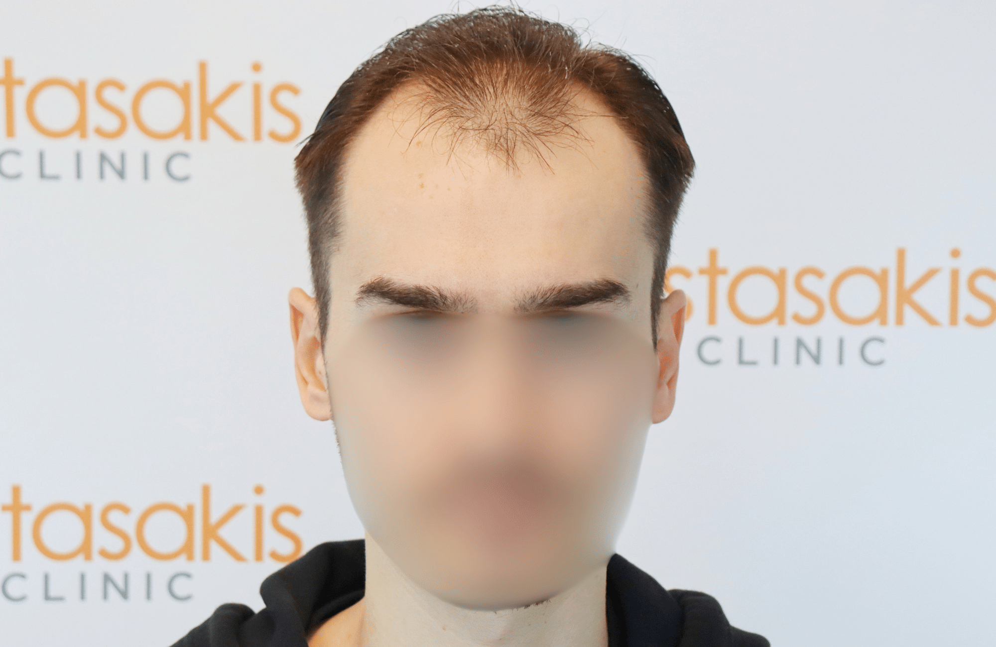hair transplant result 2600 fus thick frontal stage 4