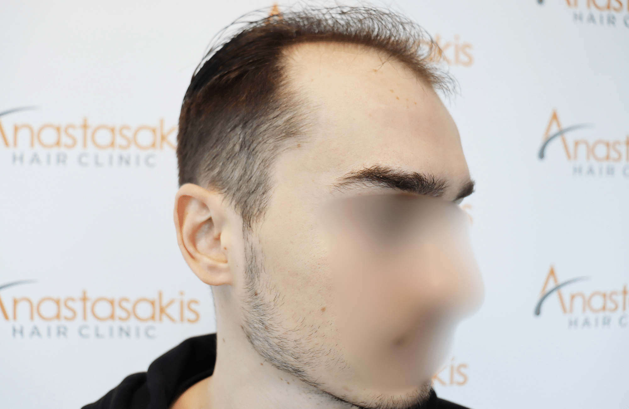 hair transplant result 2600 fus thick frontal stage 4 (3)