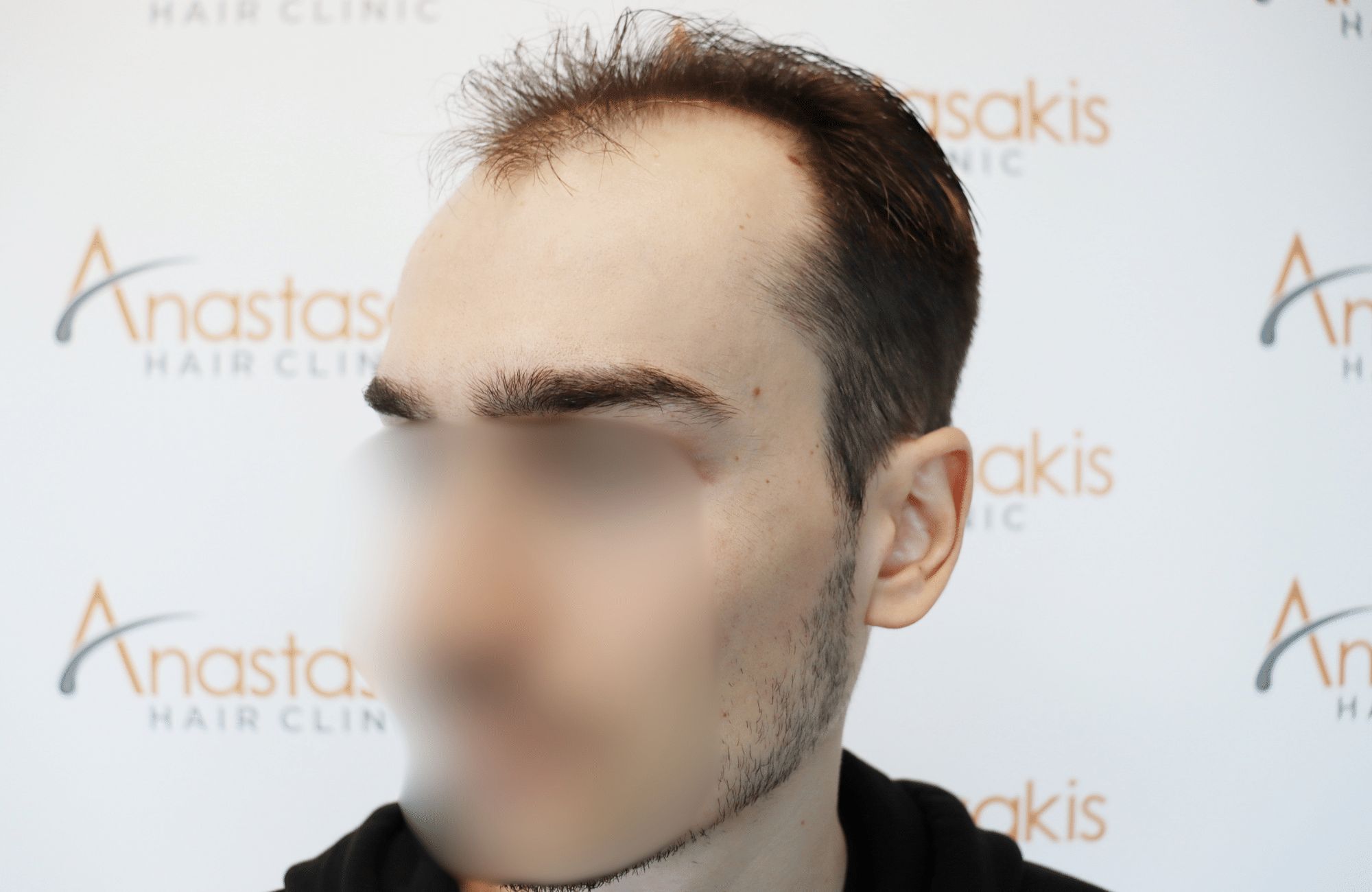 hair transplant result 2600 fus thick frontal stage 4 (3)