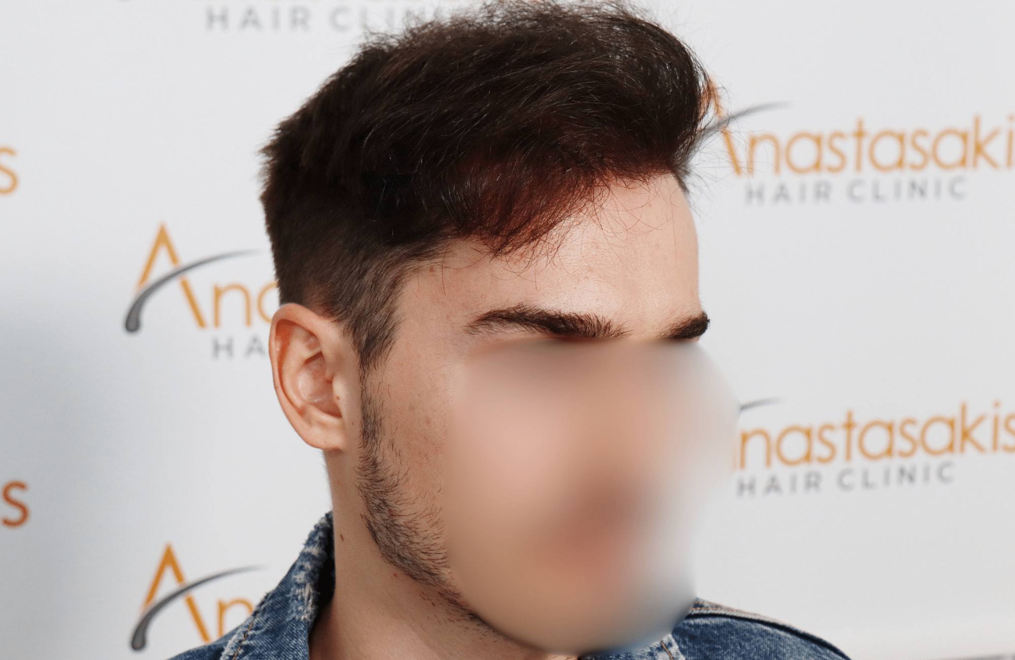 hair transplant result 2600 fus thick frontal stage 4 (3)