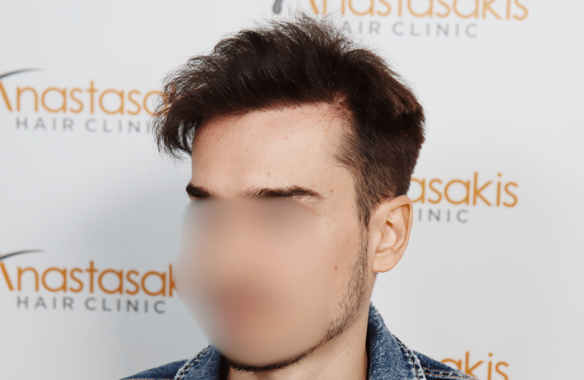 hair transplant result 2600 fus thick frontal stage 4 (3)