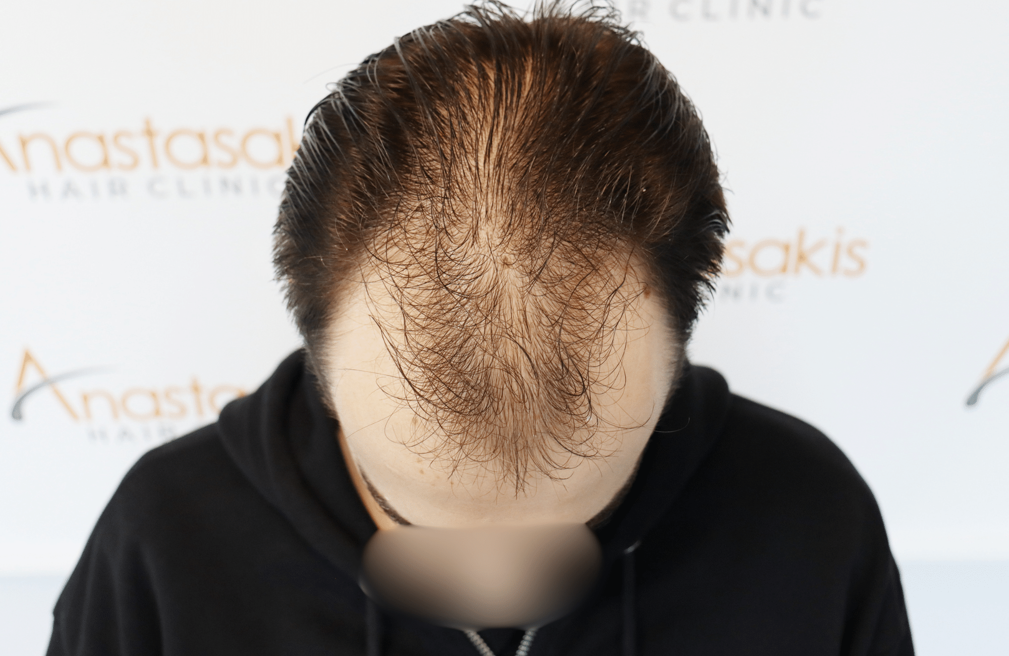 hair transplant result 2600 fus thick frontal stage 4 (3)