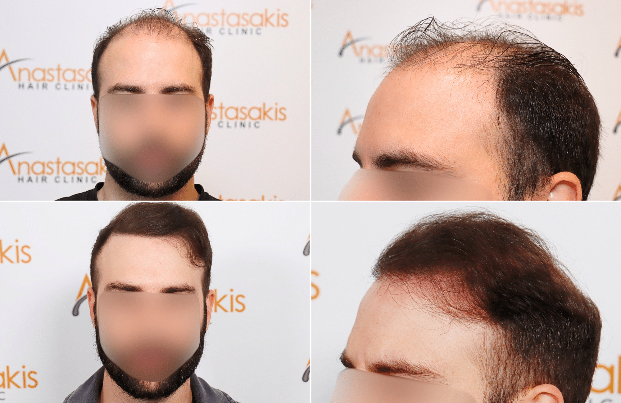 https://www.anastasakishairclinic.gr/portfolio/apotelesma-metamosxefsis-mallion-anastasakis-hair-clinic-62/