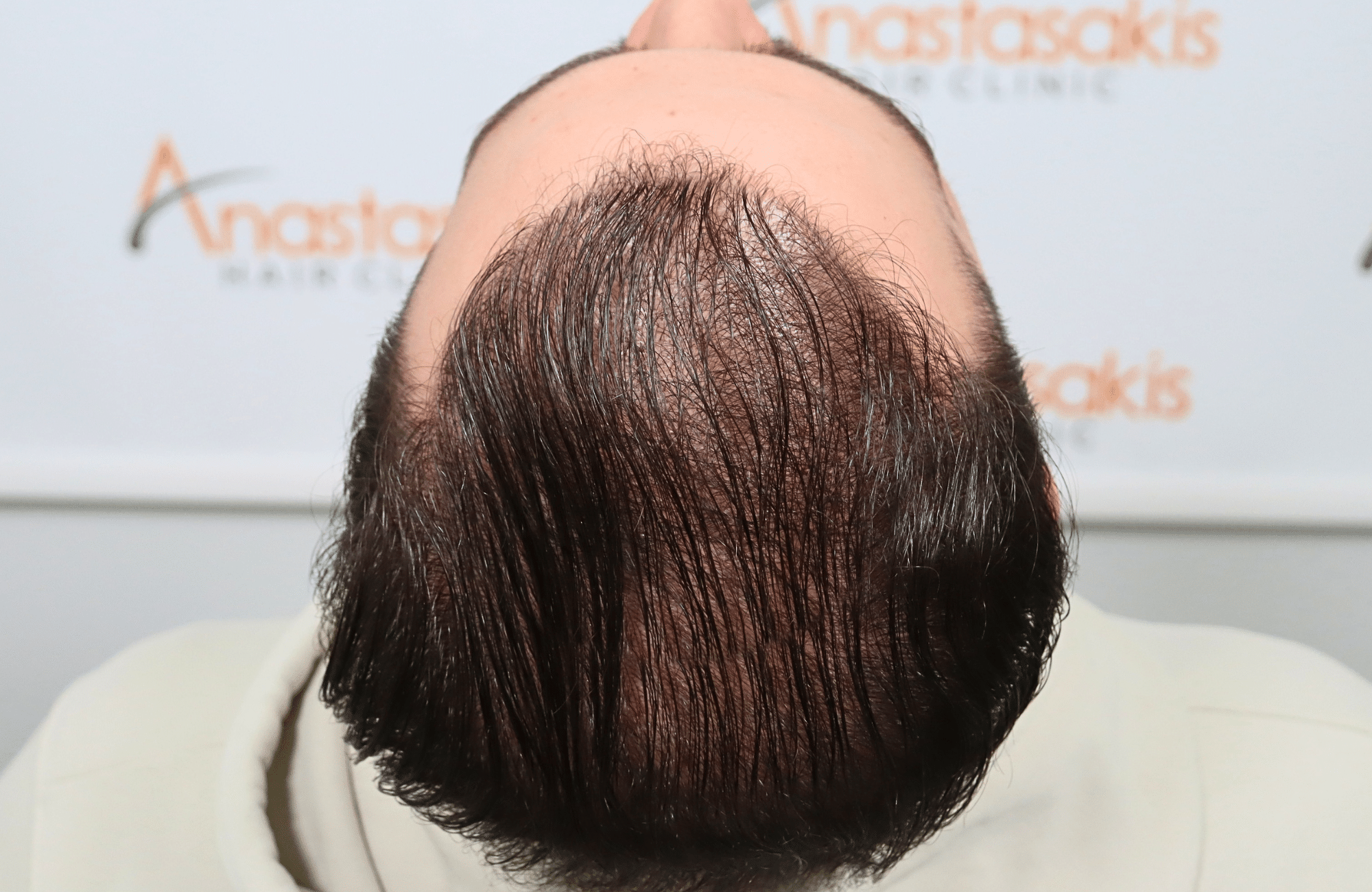 hair transplant result 2600 fus very thin (1)