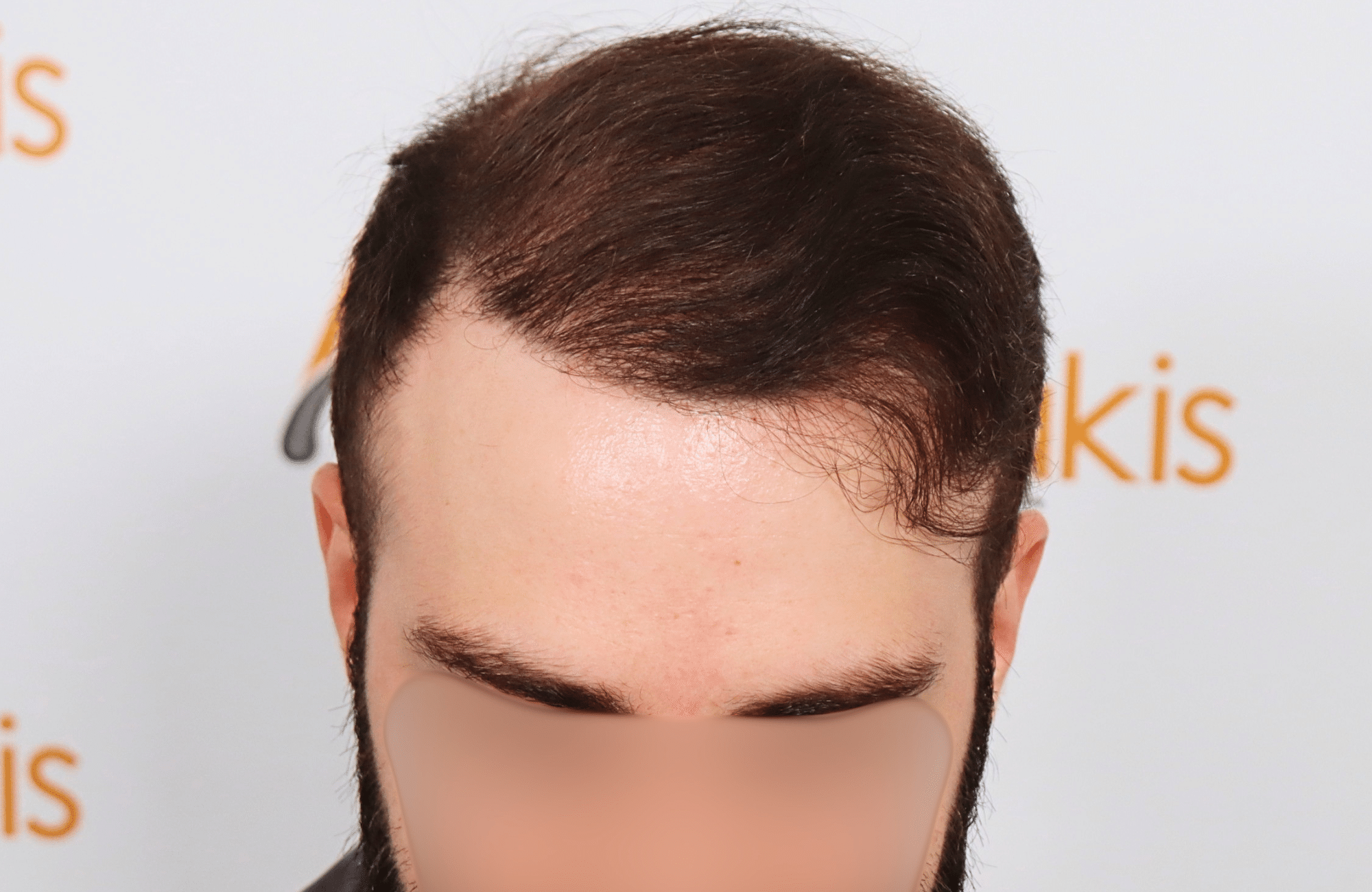hair transplant result 2600 fus very thin (10)