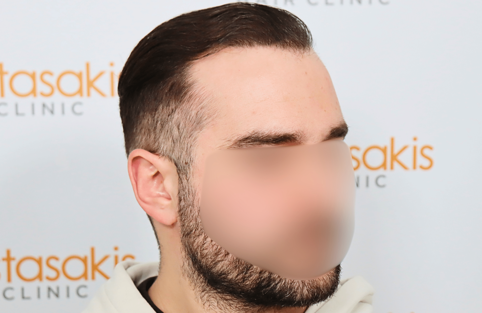 hair transplant result 2600 fus very thin (10)