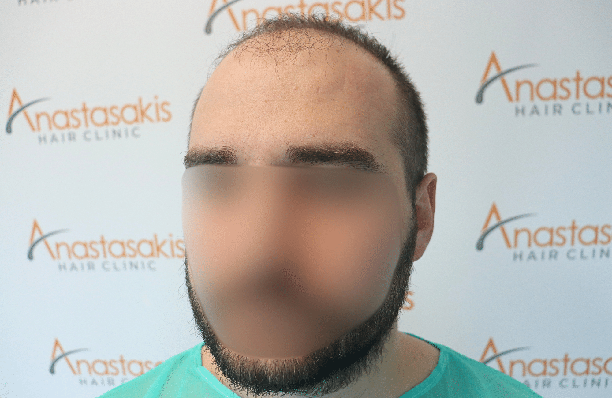 hair transplant result 2600 fus very thin (11)