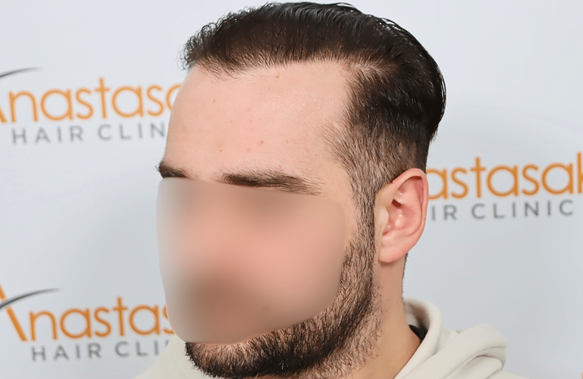 hair transplant result 2600 fus very thin (12)