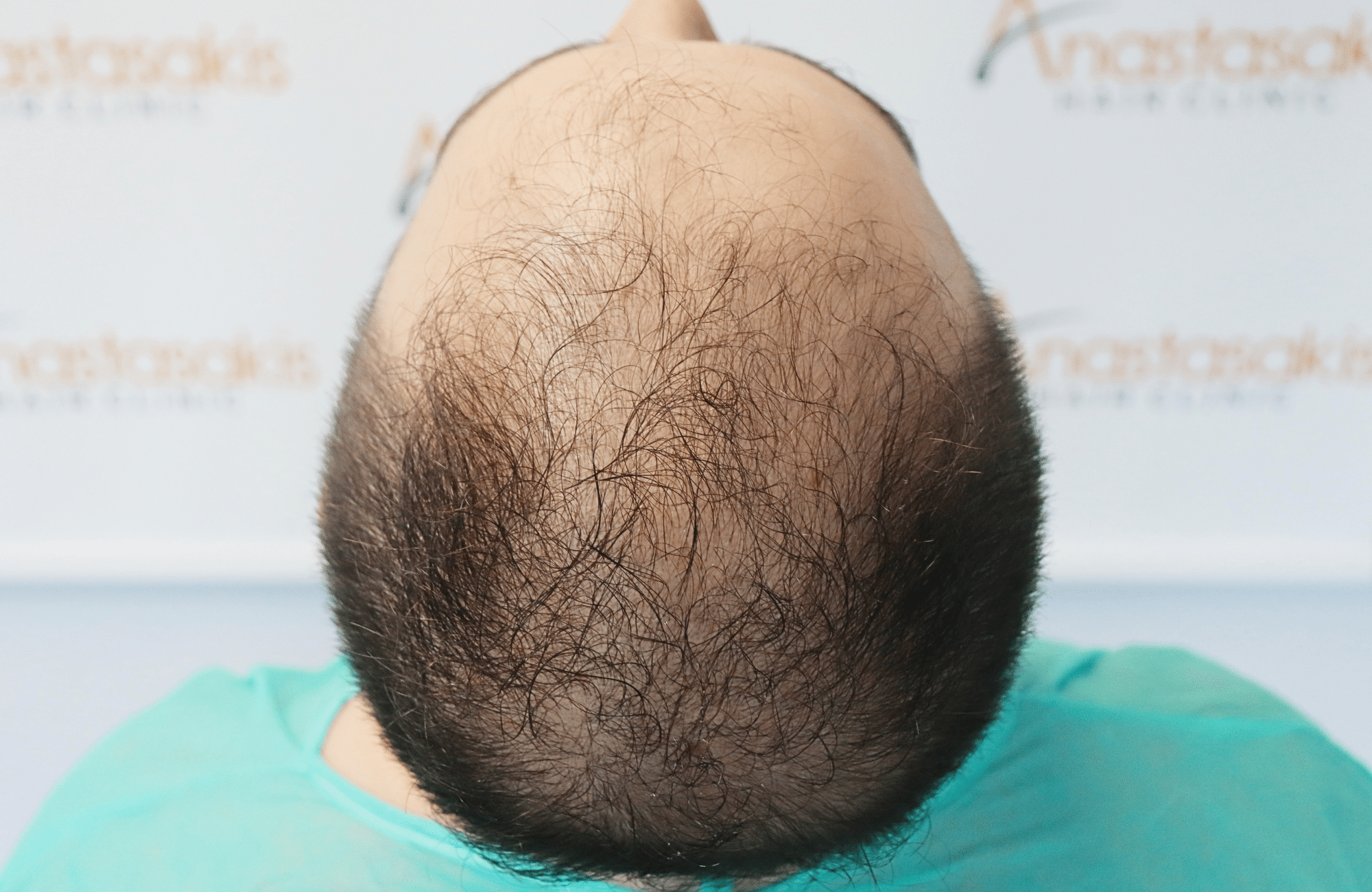 hair transplant result 2600 fus very thin (13)