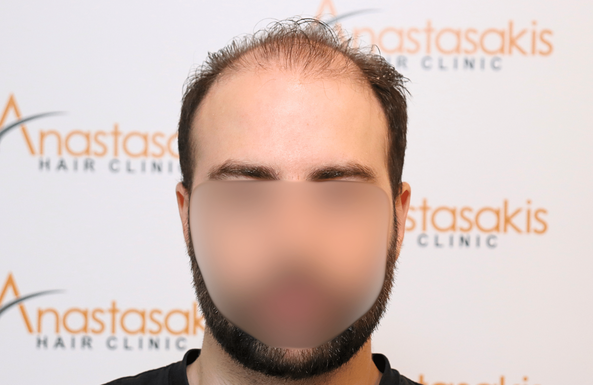 hair transplant result 2600 fus very thin (3)