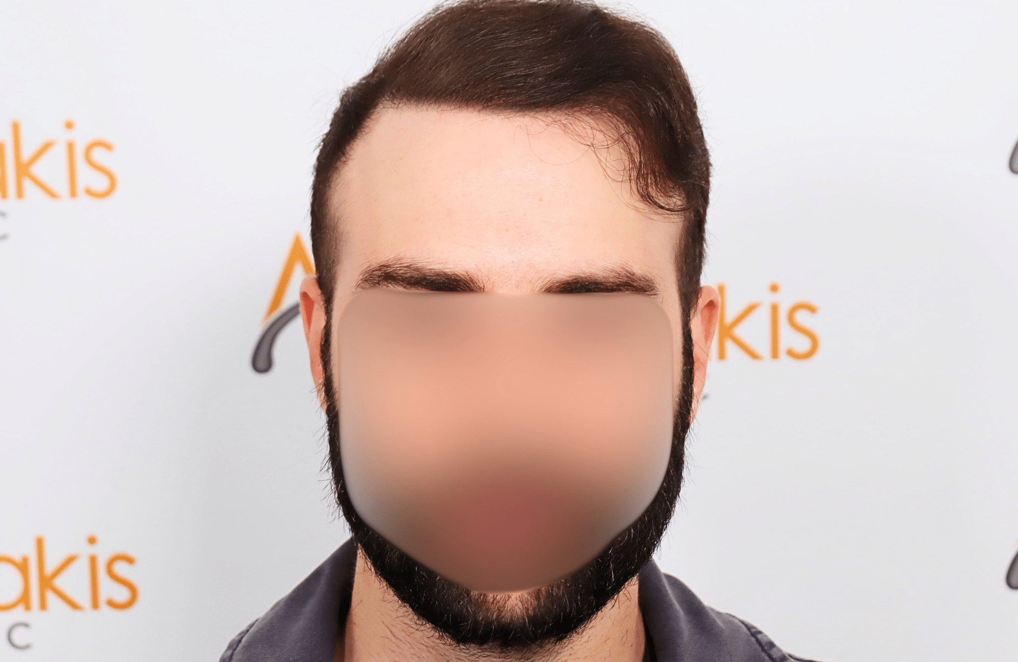hair transplant result 2600 fus very thin (4)