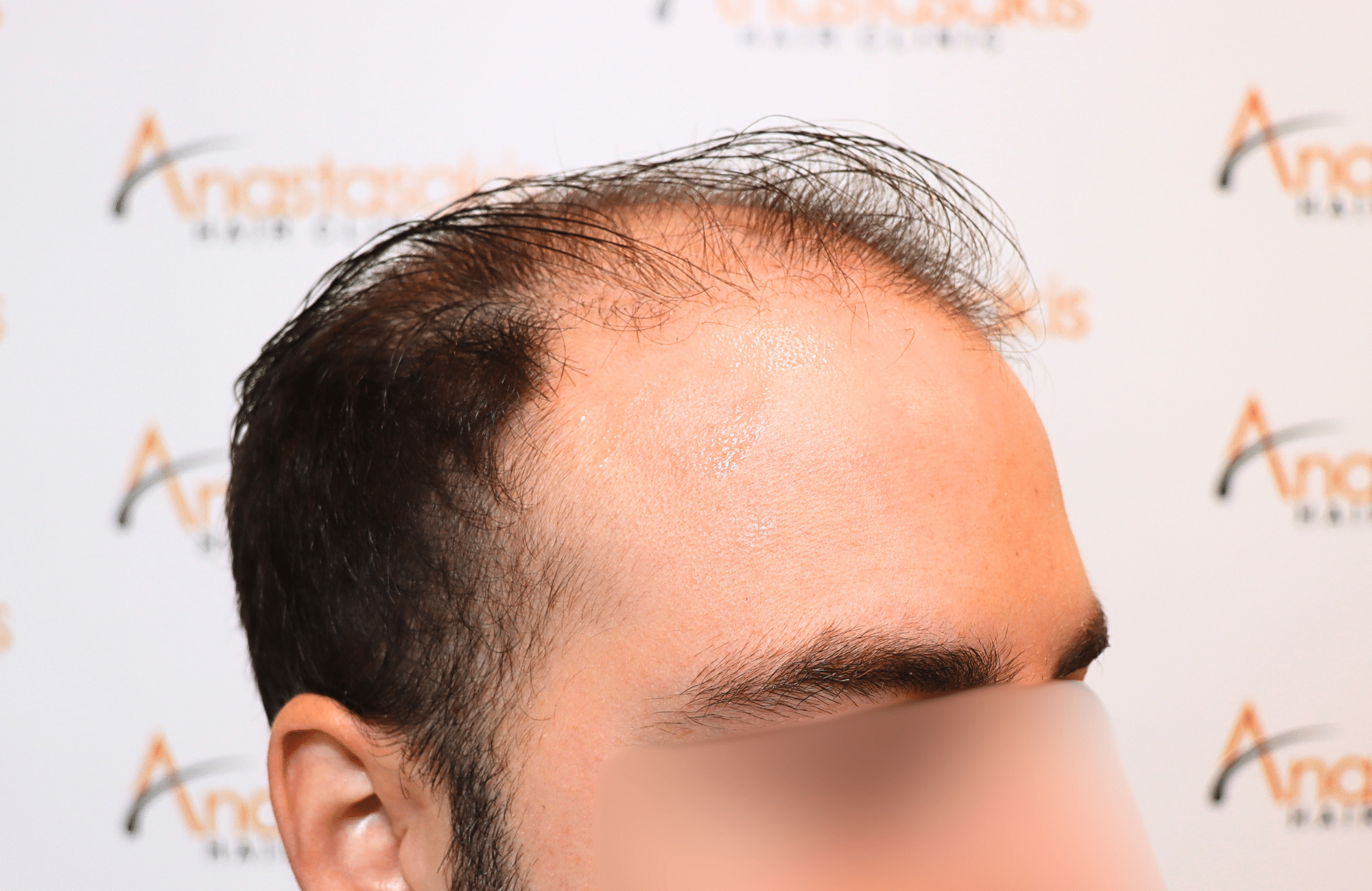 hair transplant result 2600 fus very thin (5)
