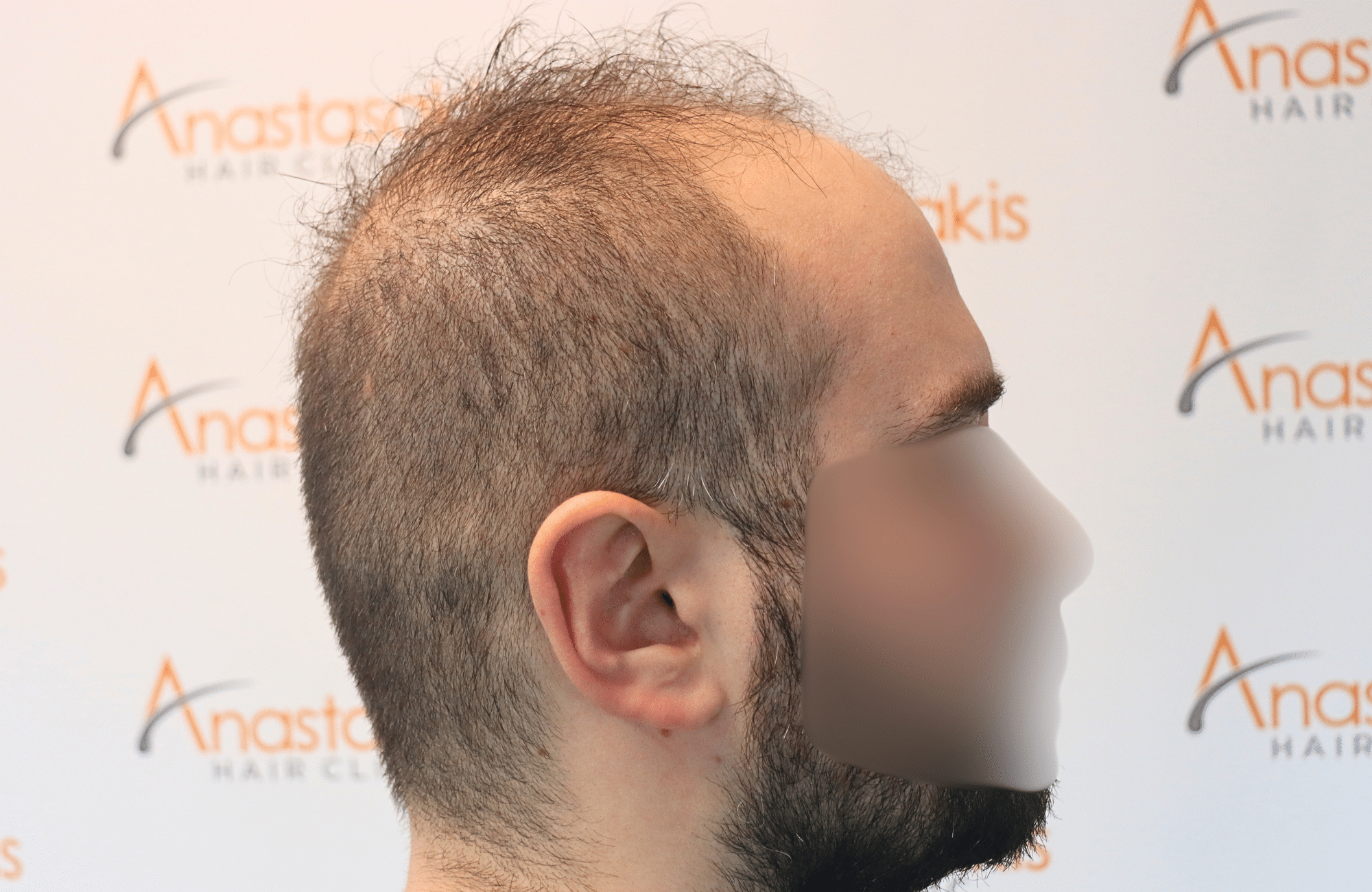 hair transplant result 2600 fus very thin (5)