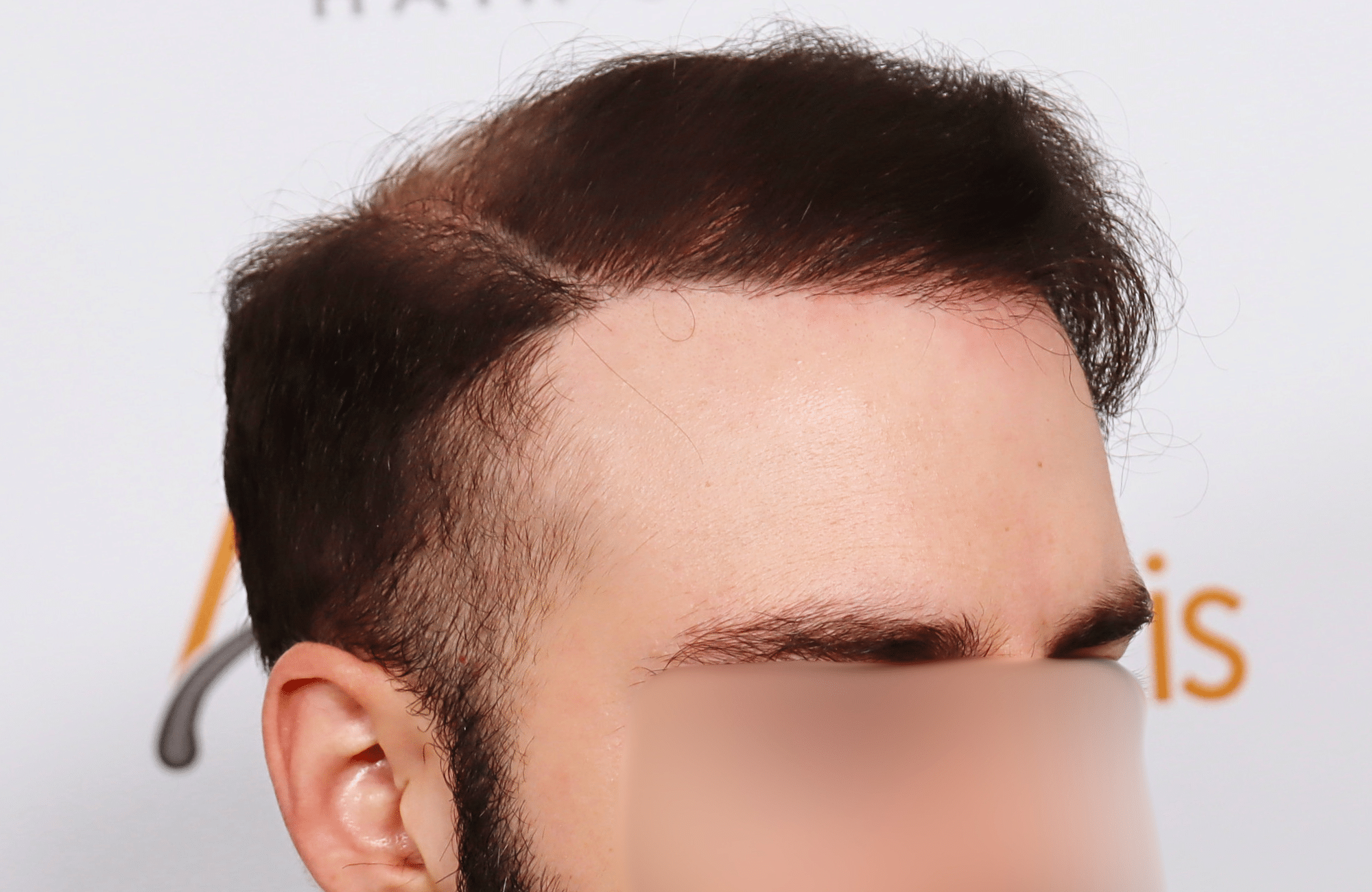 hair transplant result 2600 fus very thin (6)
