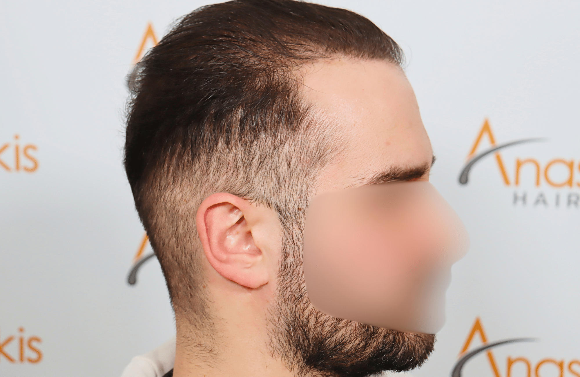 hair transplant result 2600 fus very thin (6)