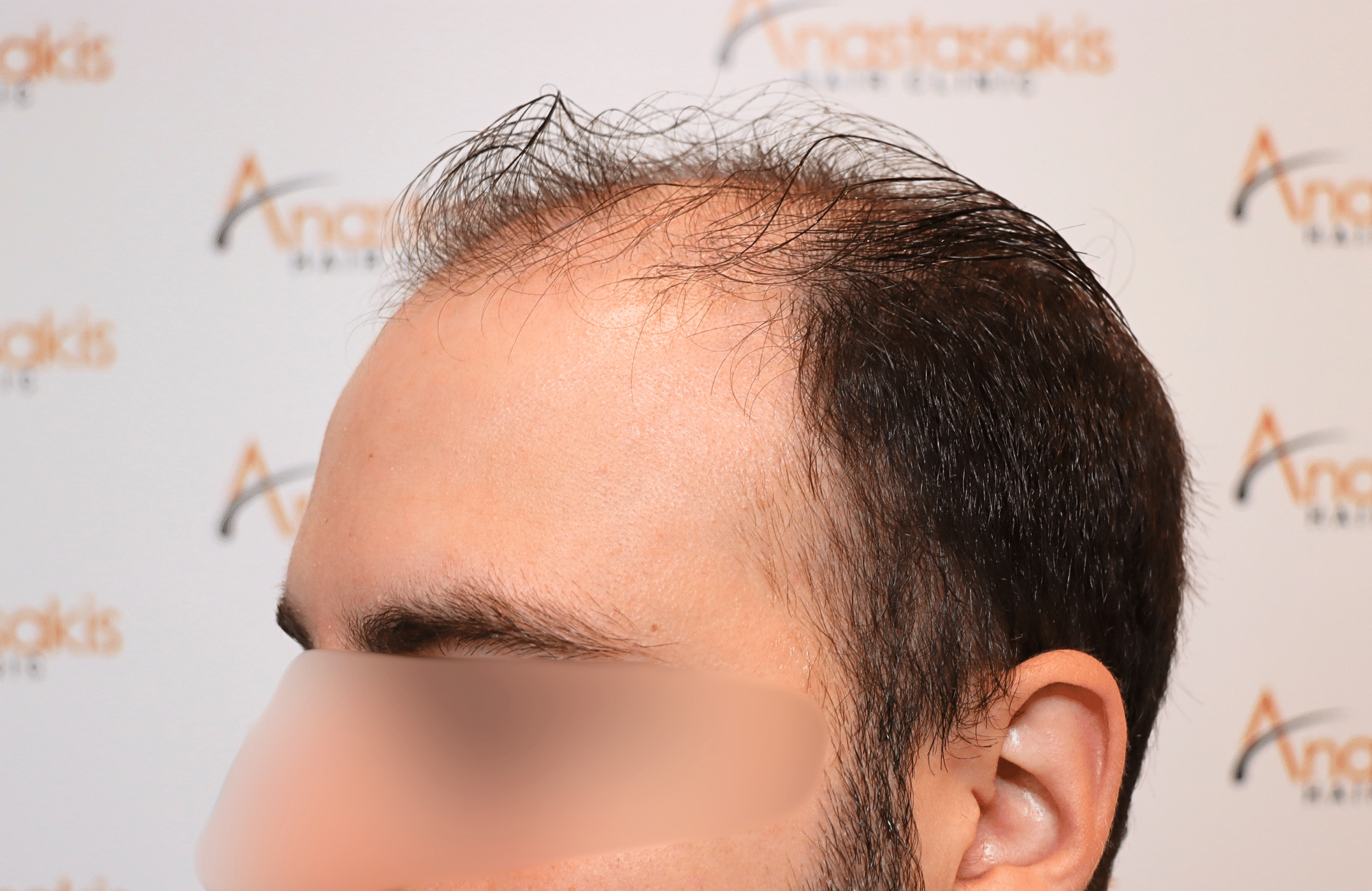 hair transplant result 2600 fus very thin (7)