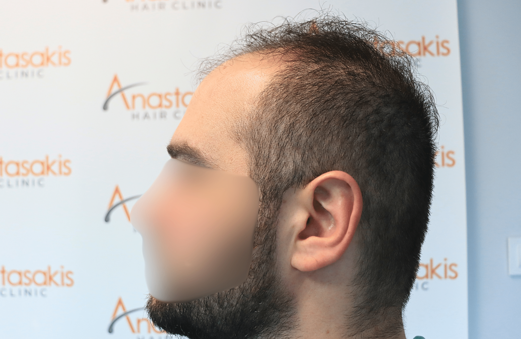 hair transplant result 2600 fus very thin (7)