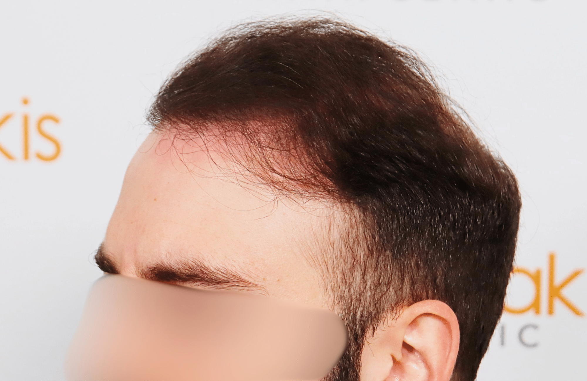 hair transplant result 2600 fus very thin (8)