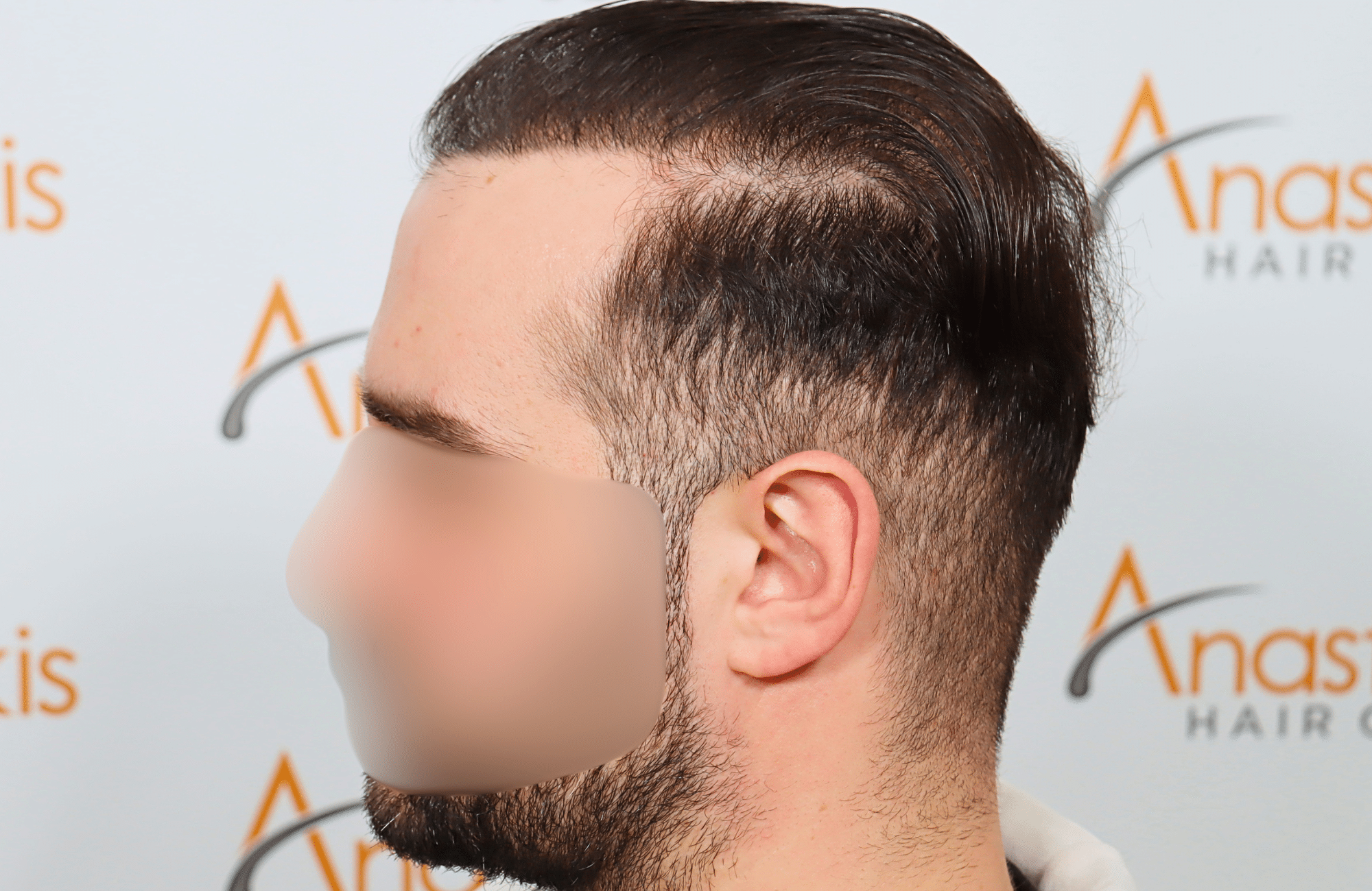 hair transplant result 2600 fus very thin (8)
