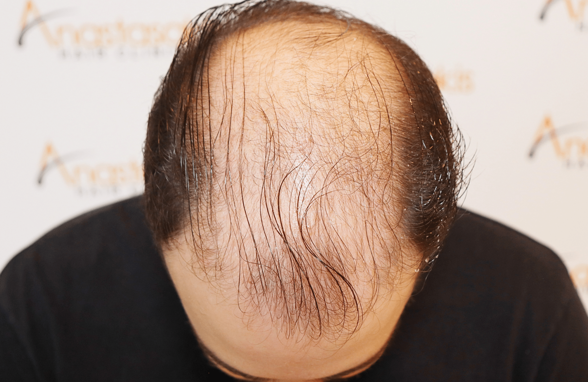 hair transplant result 2600 fus very thin (9)