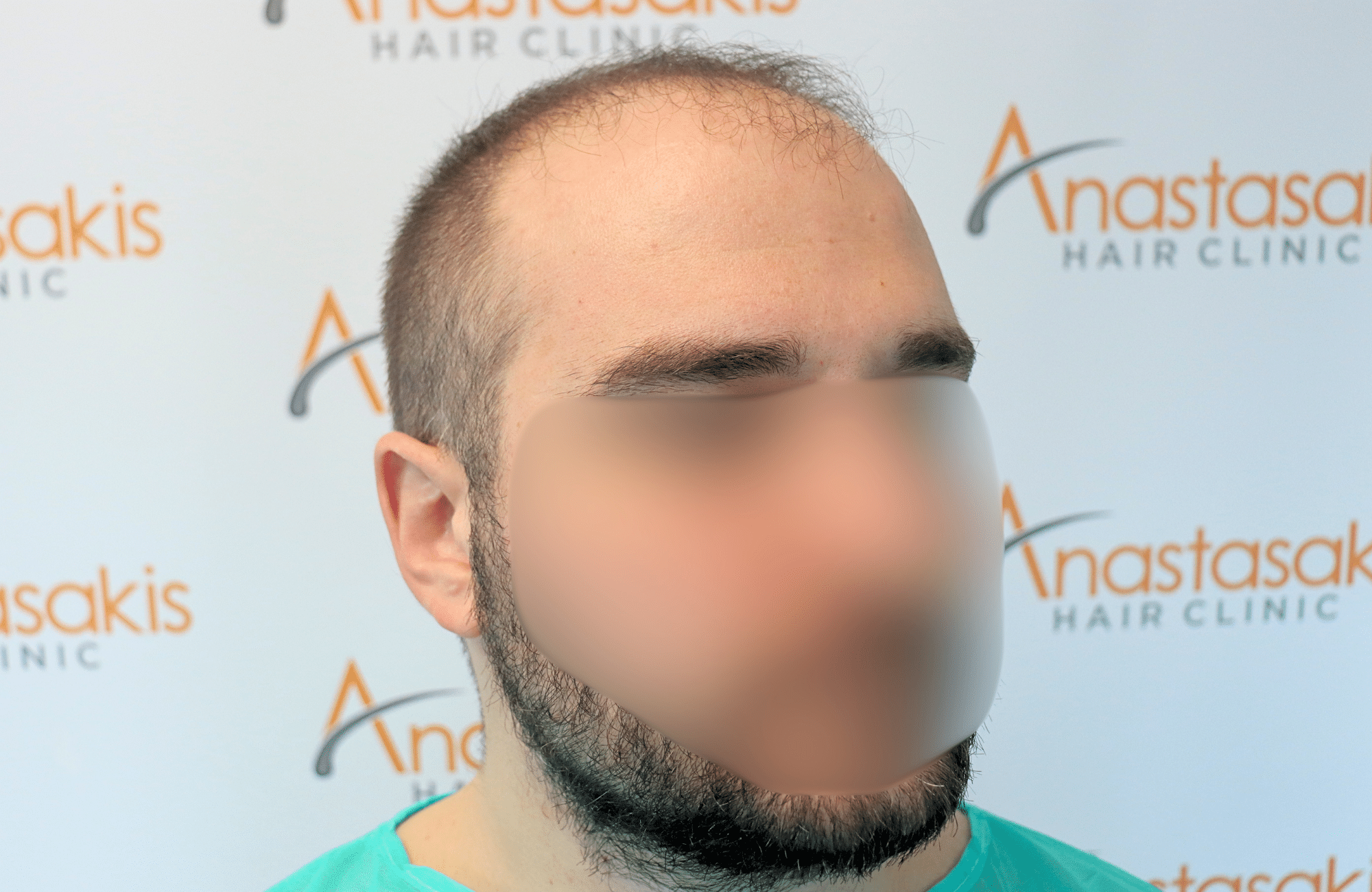 hair transplant result 2600 fus very thin (9)