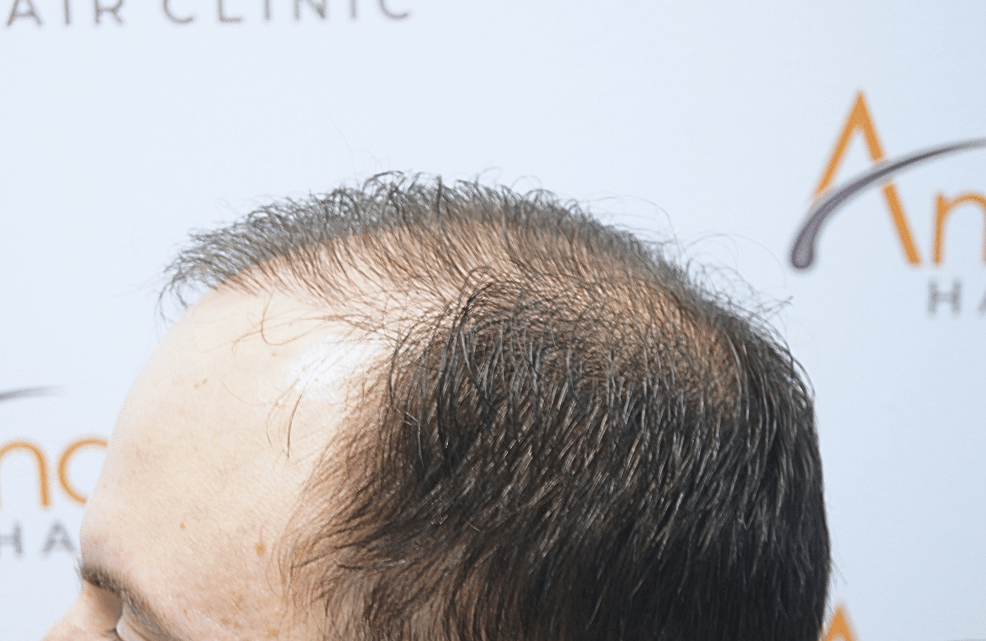 hair transplant result
