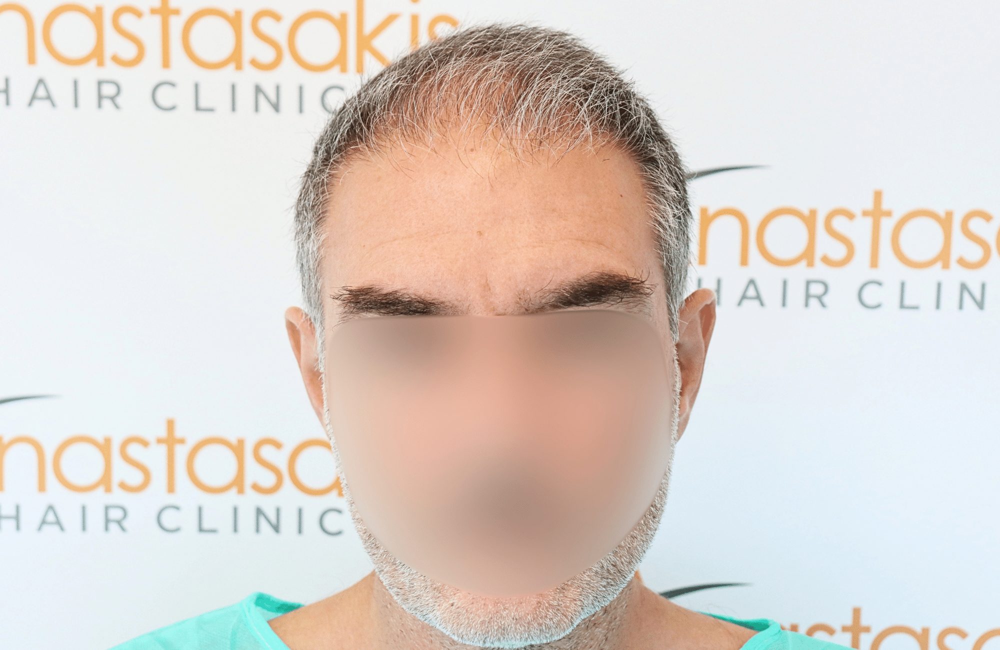 hair transplant result 3000 fus grey diffuse thin