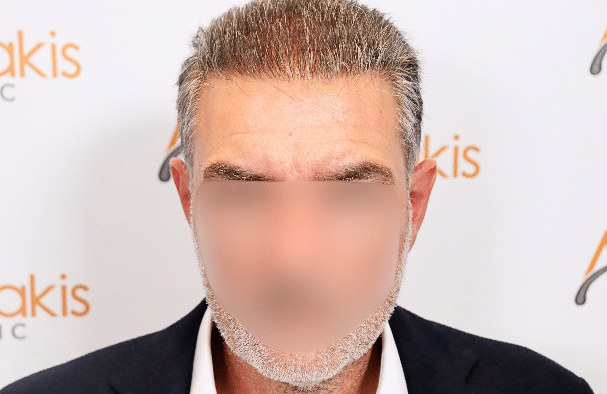 hair transplant result 3000 fus grey diffuse thin