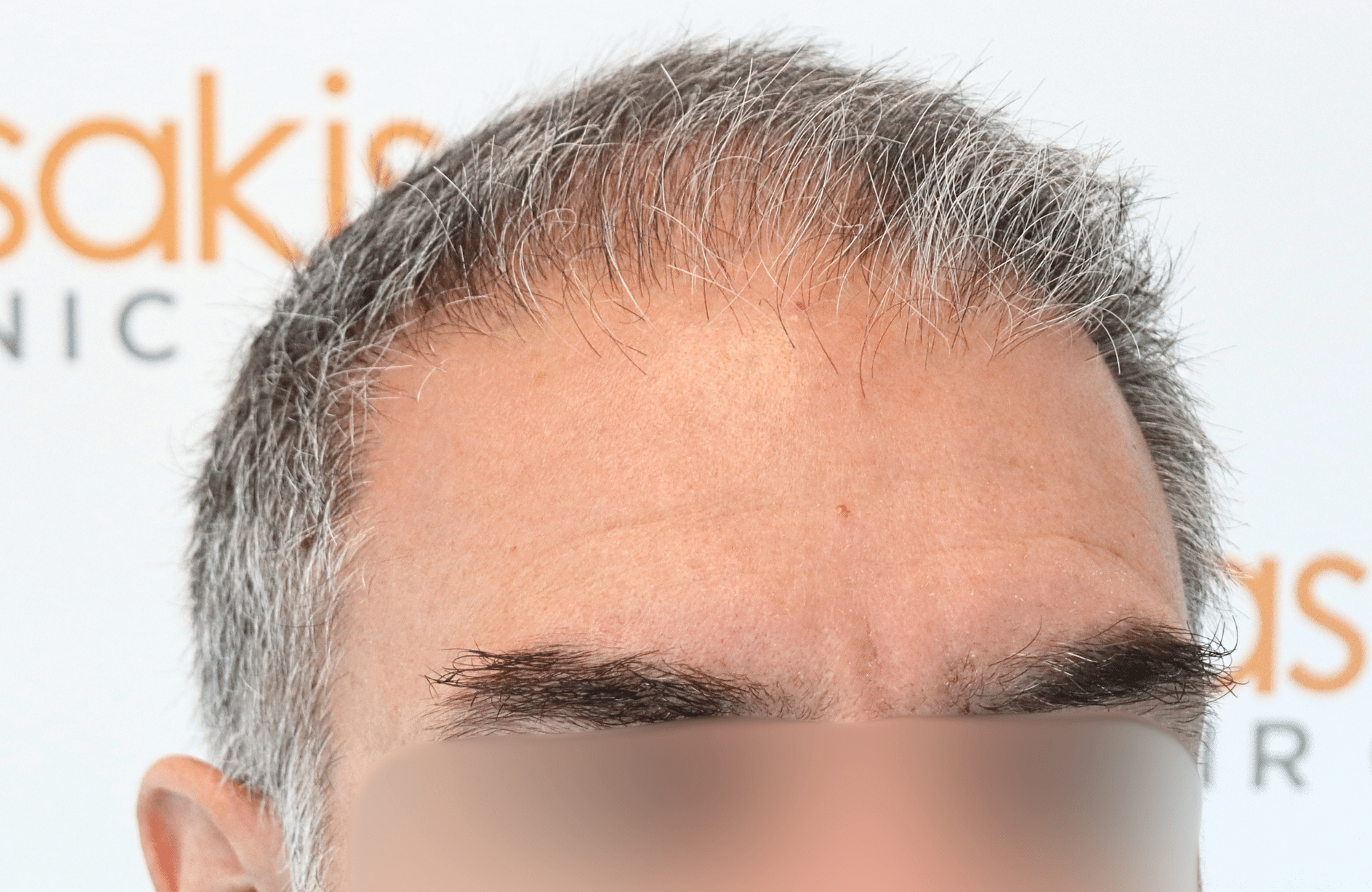 hair transplant result 3000 fus grey diffuse thin