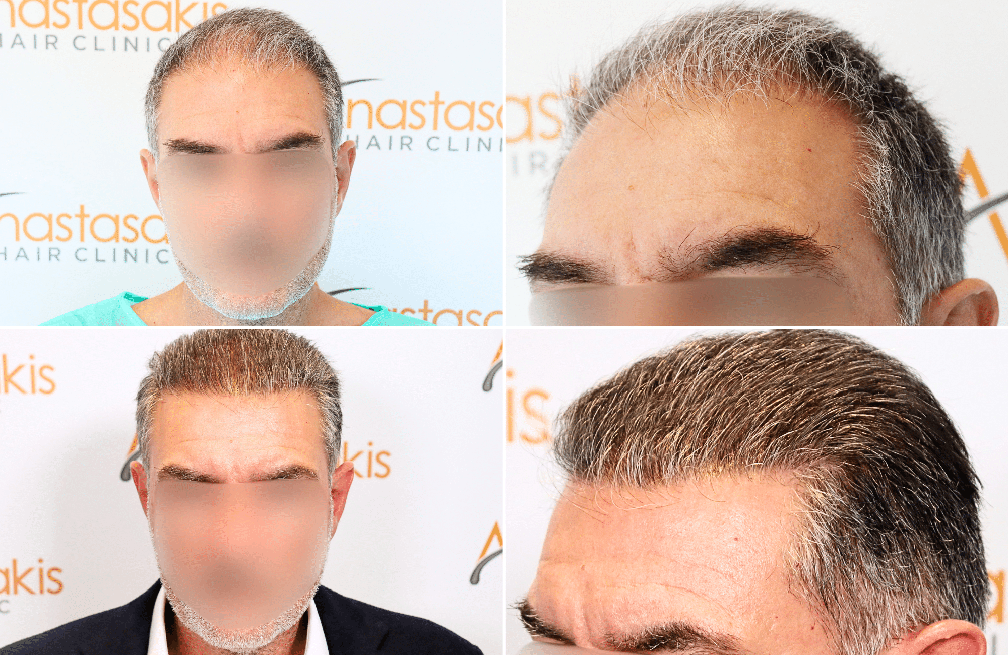 https://www.anastasakishairclinic.gr/portfolio/apotelesma-metamosxefsis-mallion-anastasakis-hair-clinic-190/