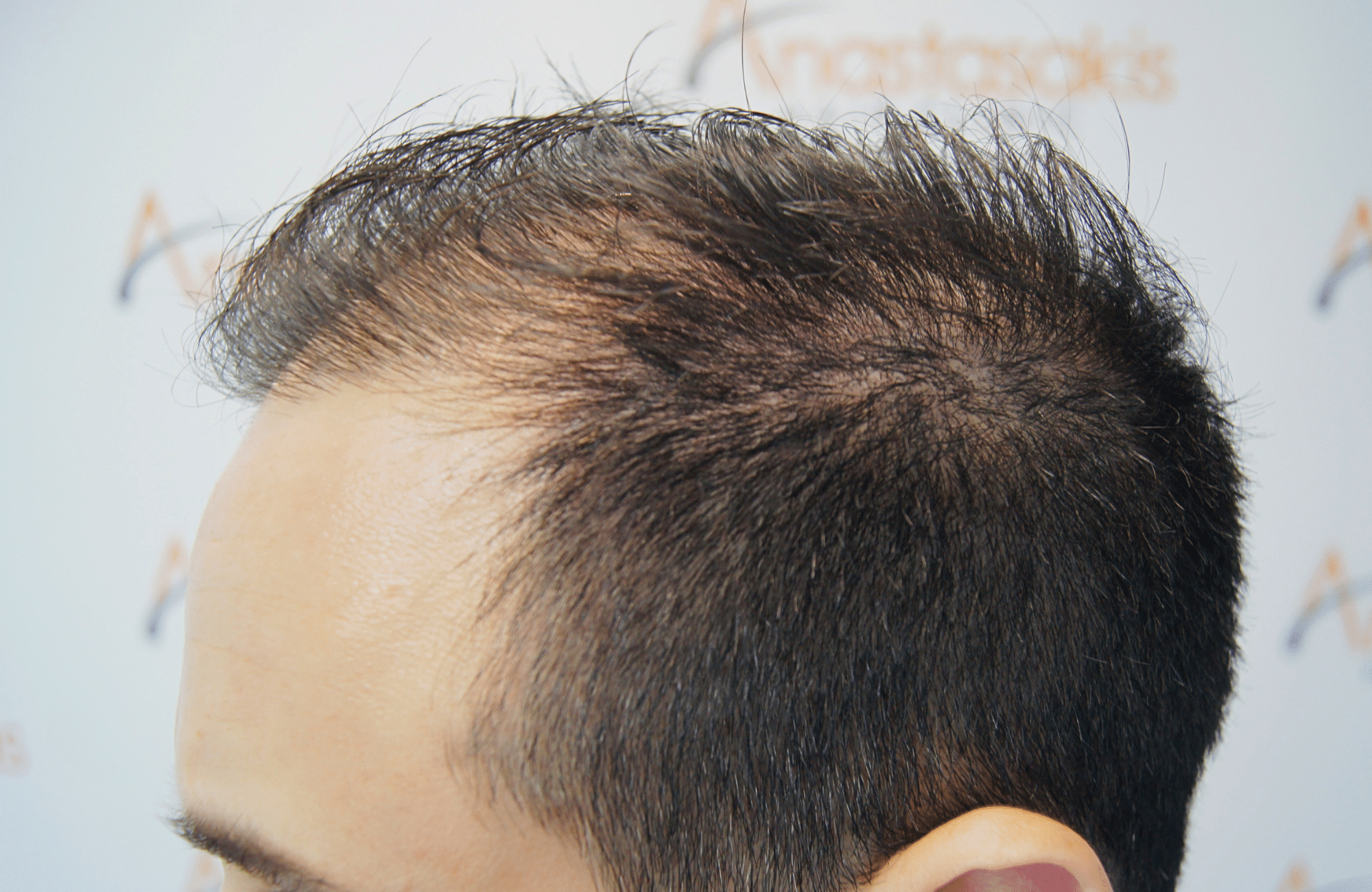 hair transplant result 3000 fus rapair case (11)