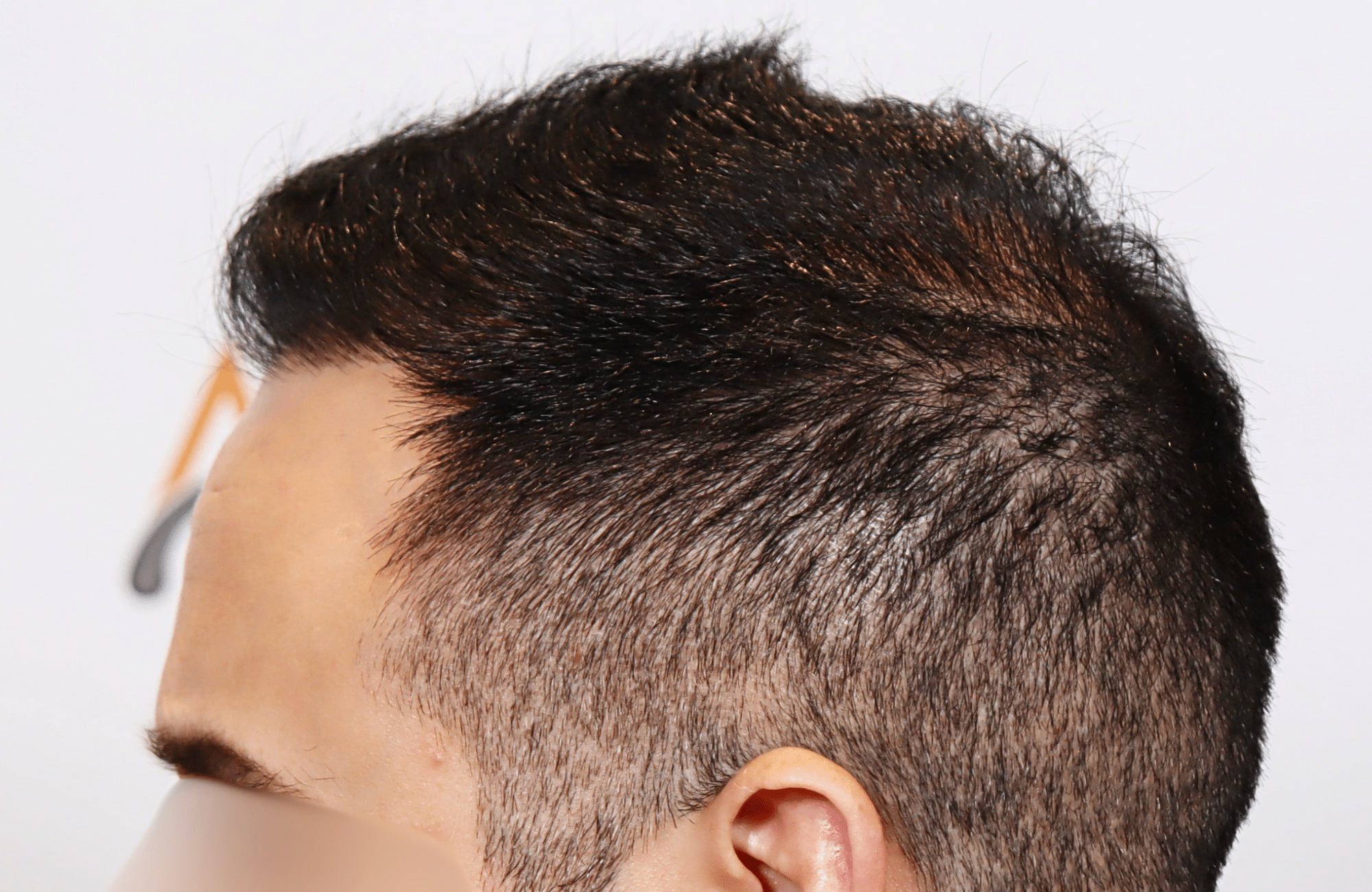 hair transplant result 3000 fus rapair case (12)