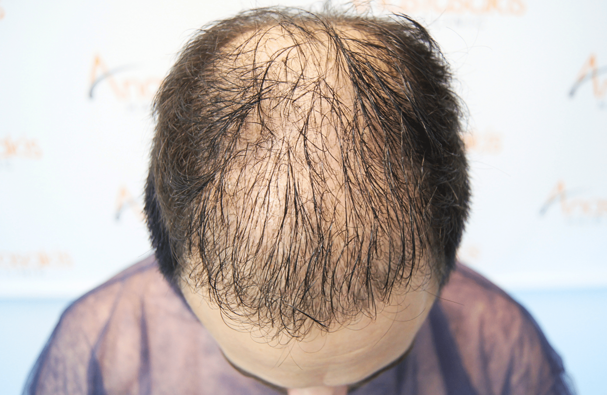 hair transplant result 3000 fus rapair case (13)