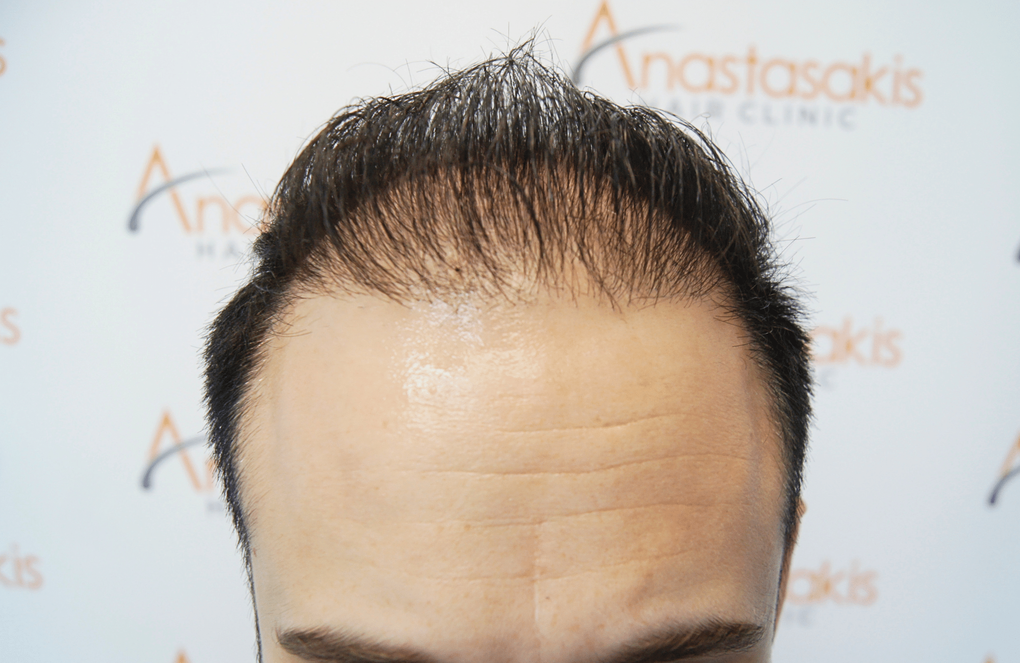 hair transplant result 3000 fus rapair case (15)