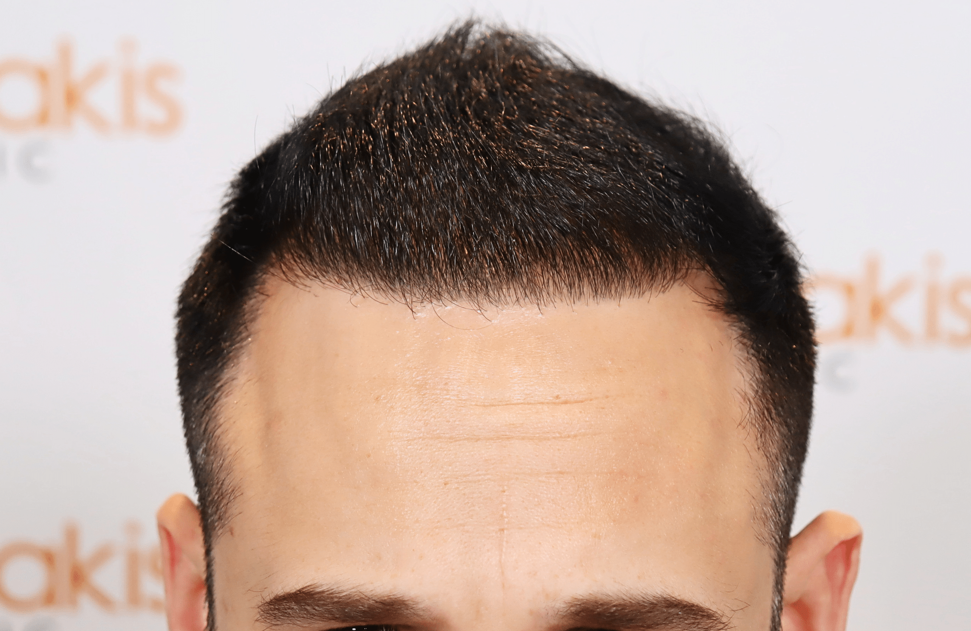 hair transplant result 3000 fus rapair case (16)