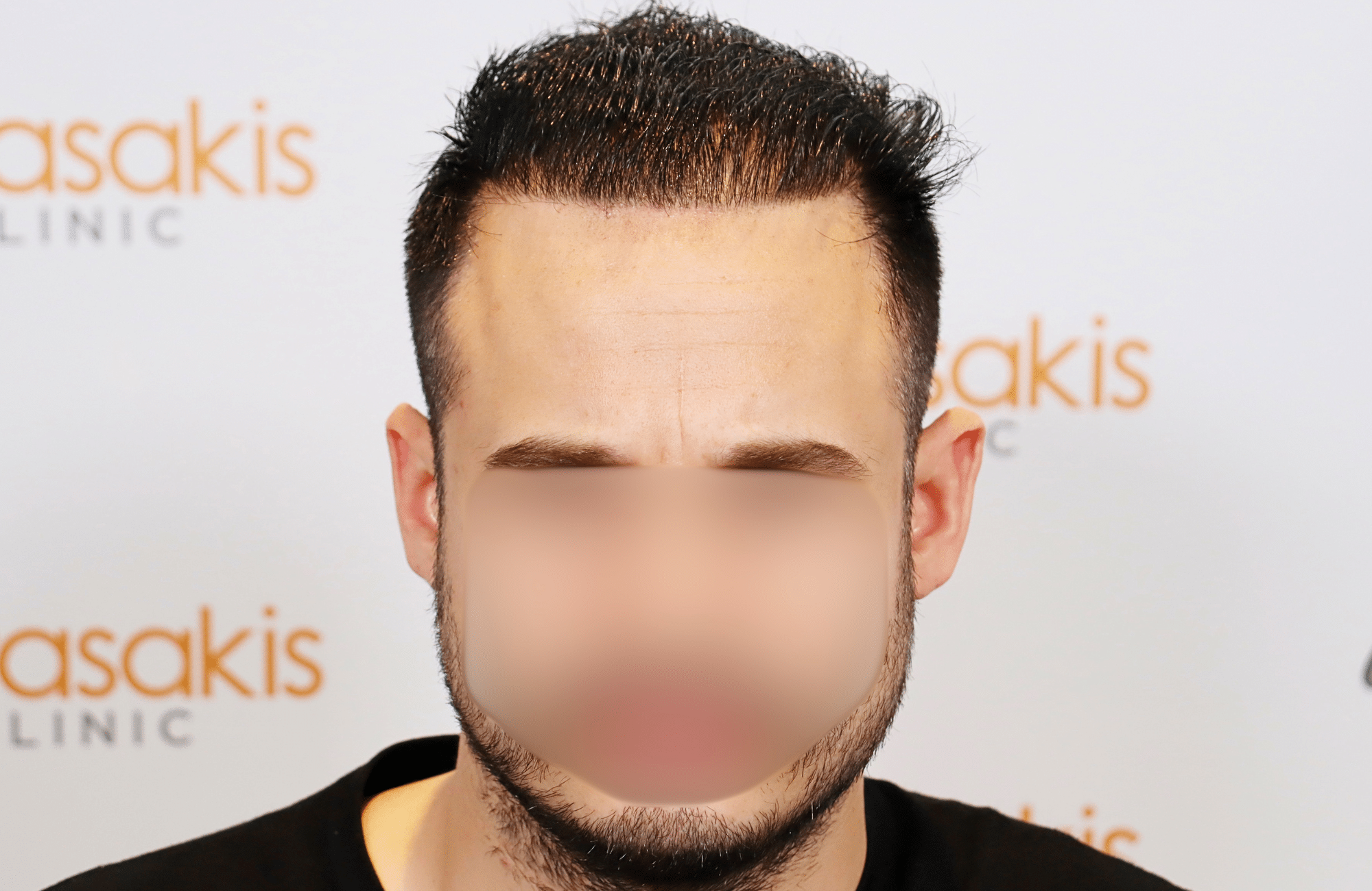 hair transplant result 3000 fus rapair case (17)