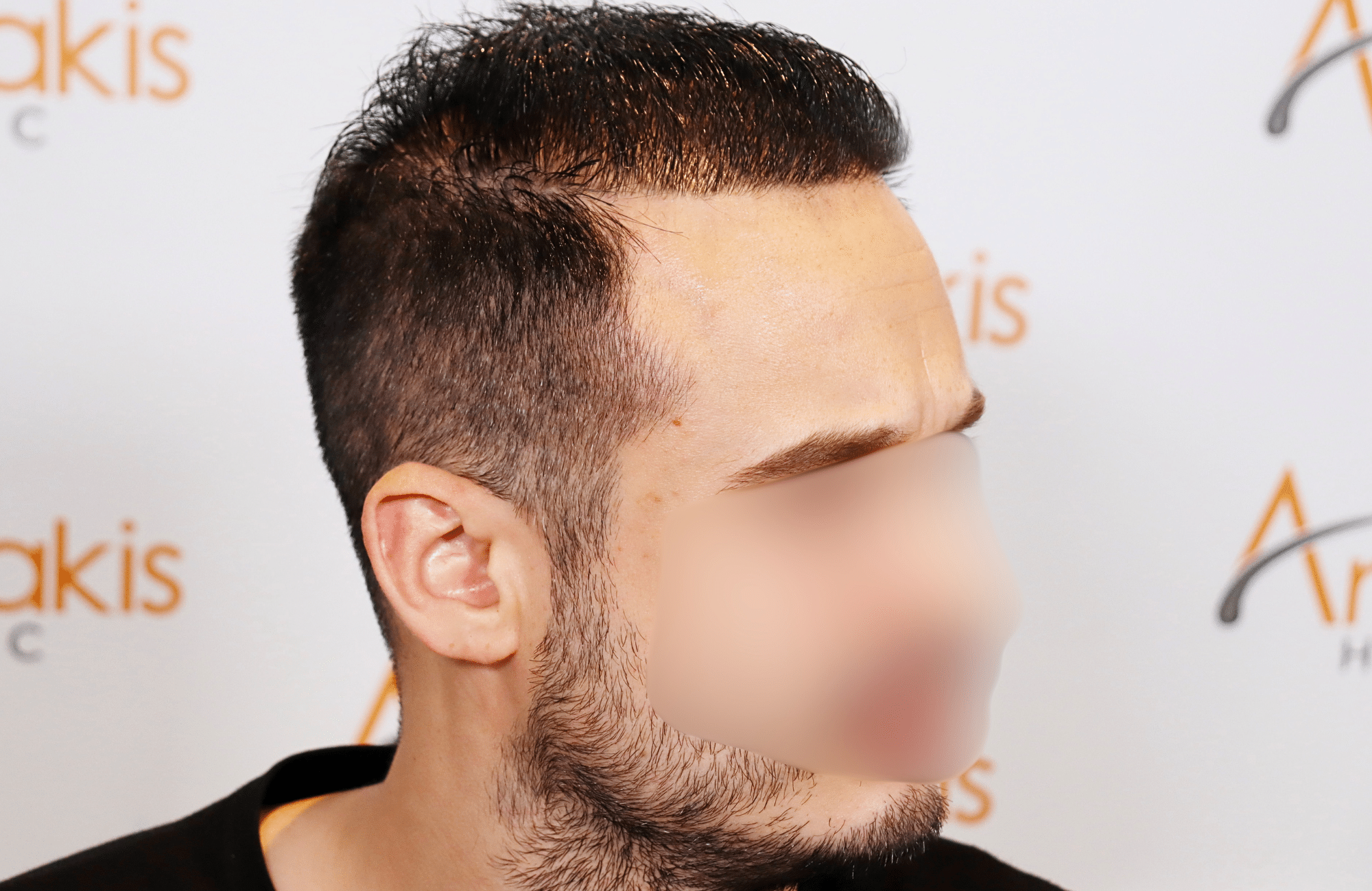 hair transplant result 3000 fus rapair case (18)
