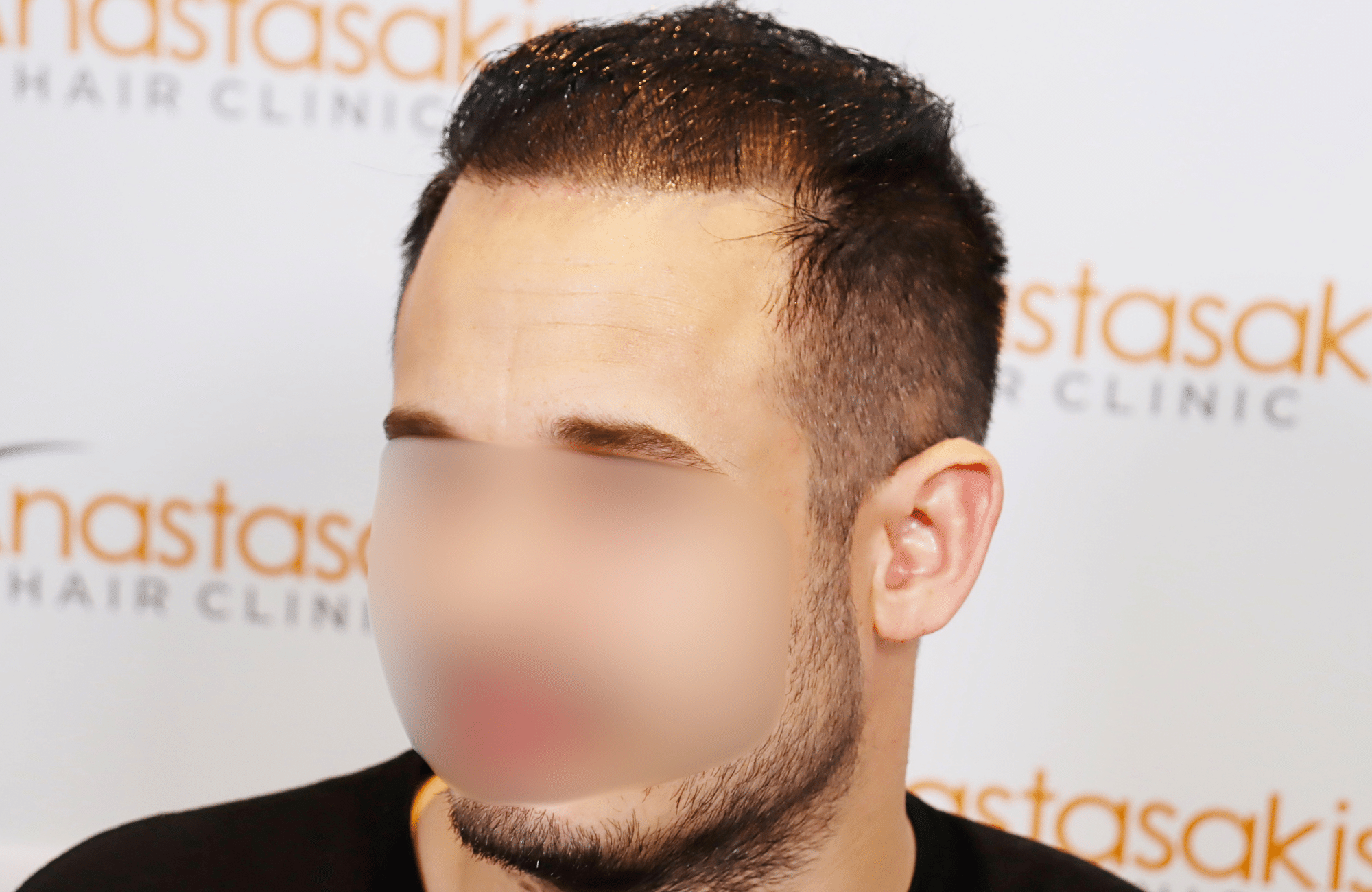 hair transplant result 3000 fus rapair case (19)